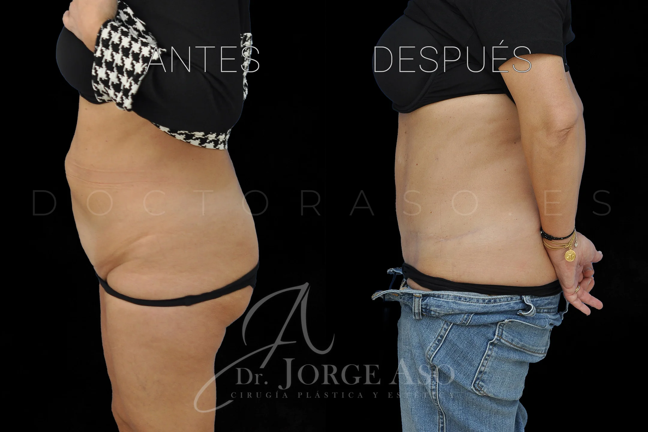 lipoabdominoplastia antes y después con reparación de diástasis de rectos vista lateral