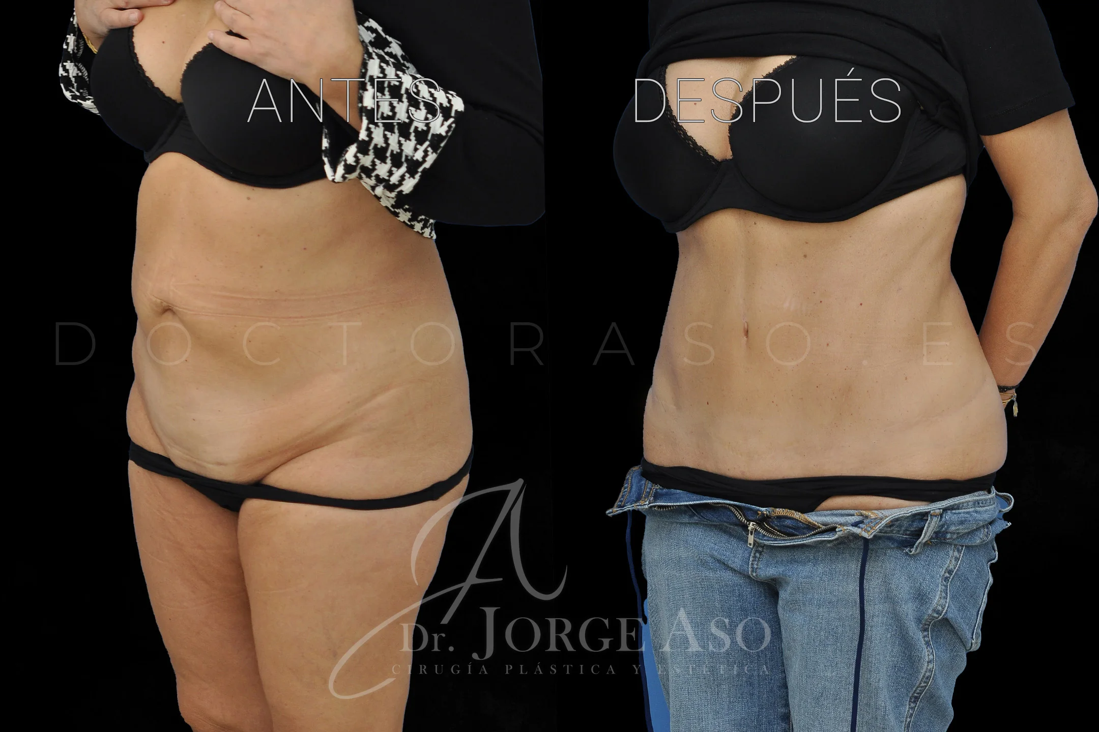 lipoabdominoplastia antes y después con reparación de diástasis de rectos vista oblicua