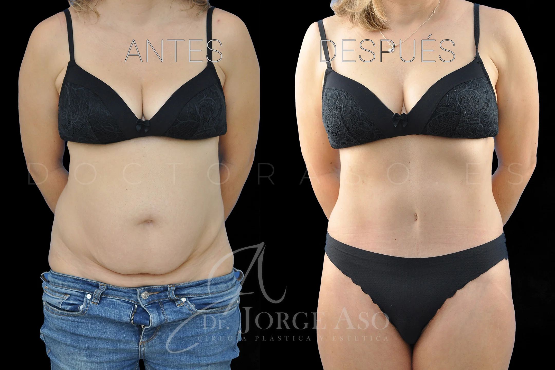 lipoabdominoplastia antes y después con reparación de diástasis de rectos vista frontal