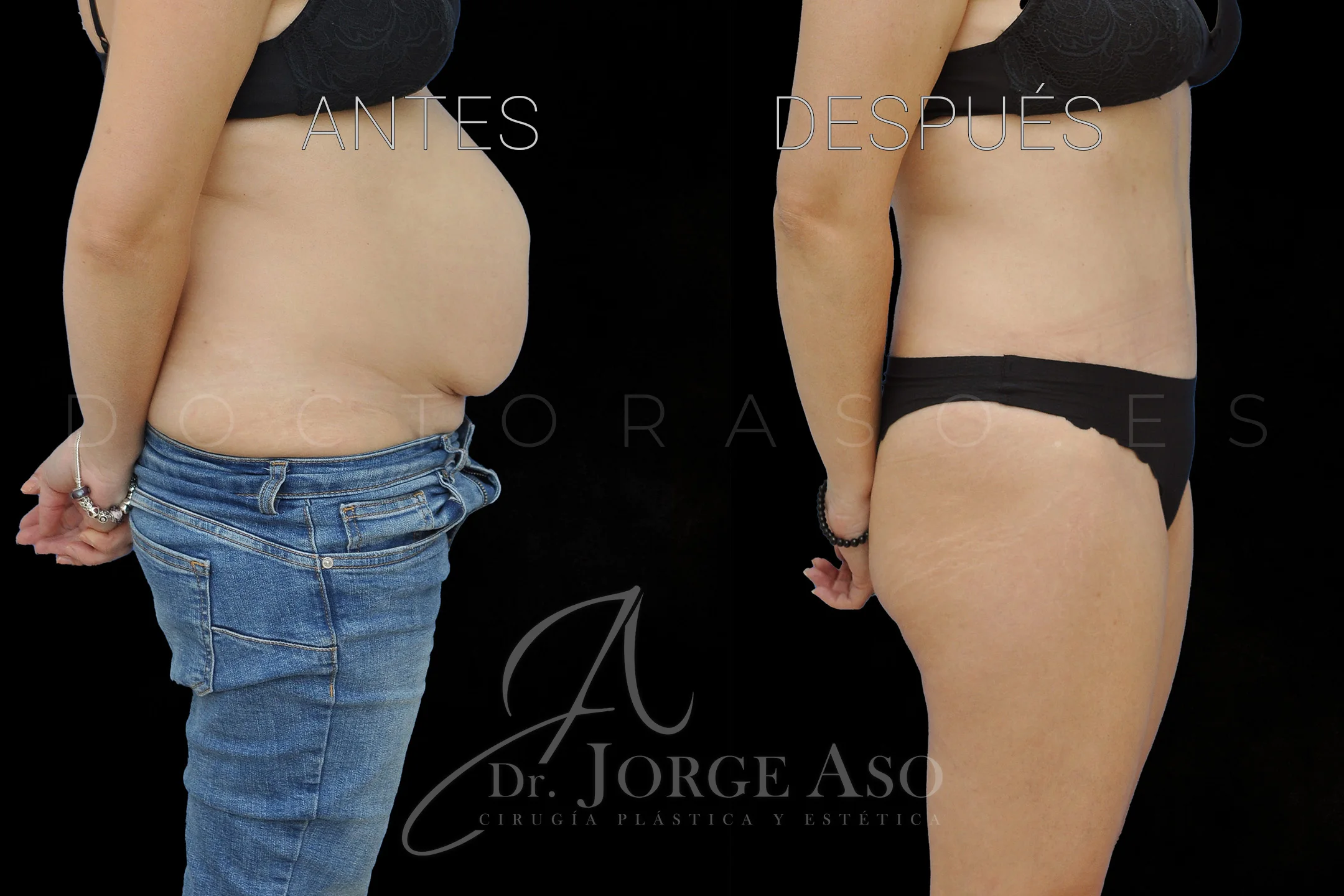 lipoabdominoplastia antes y después con reparación de diástasis de rectos vista lateral