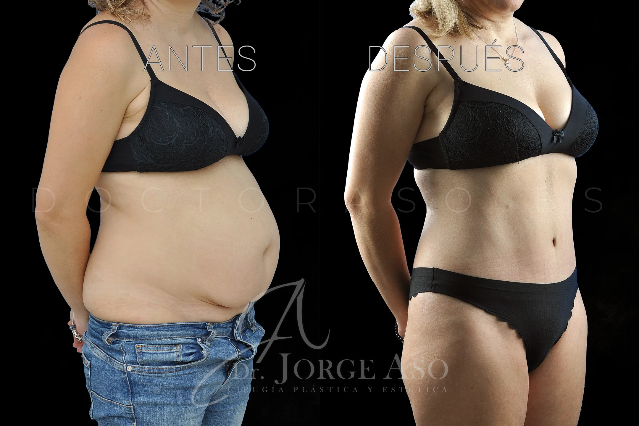 lipoabdominoplastia antes y después con reparación de diástasis de rectos vista oblicua