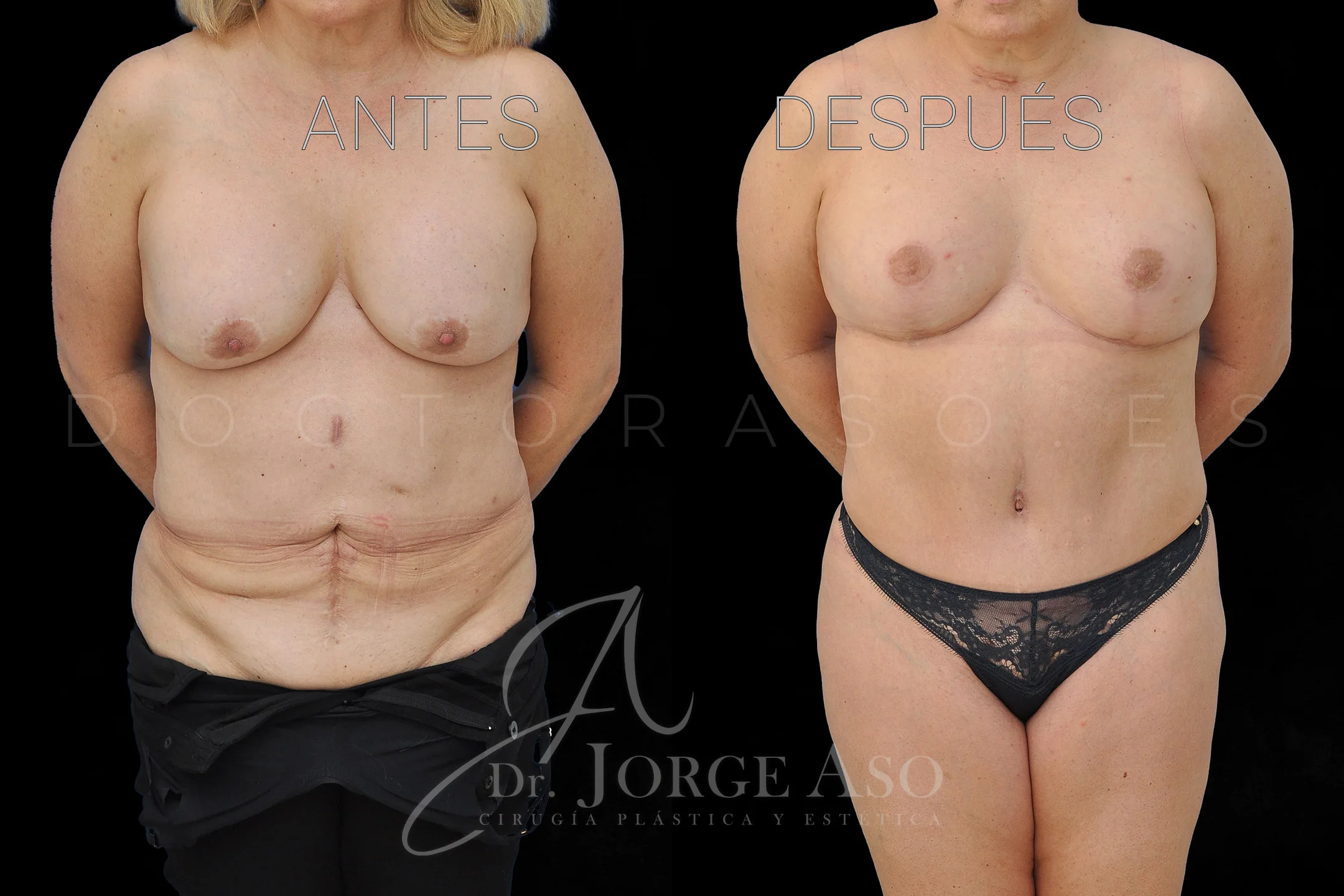 lipoabdominoplastia antes y después con reparación de diástasis de rectos vista frontal