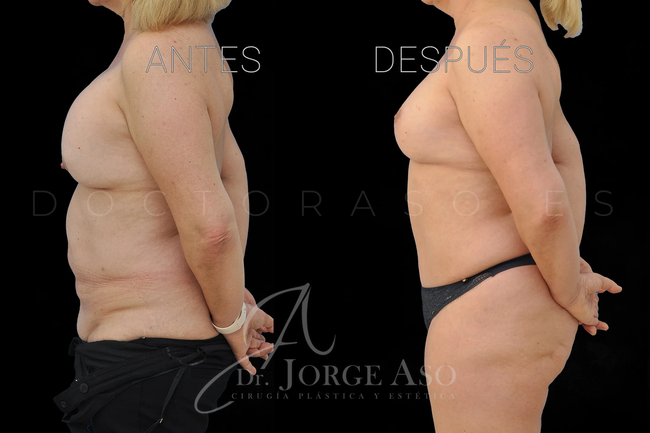 lipoabdominoplastia antes y después con reparación de diástasis de rectos vista lateral