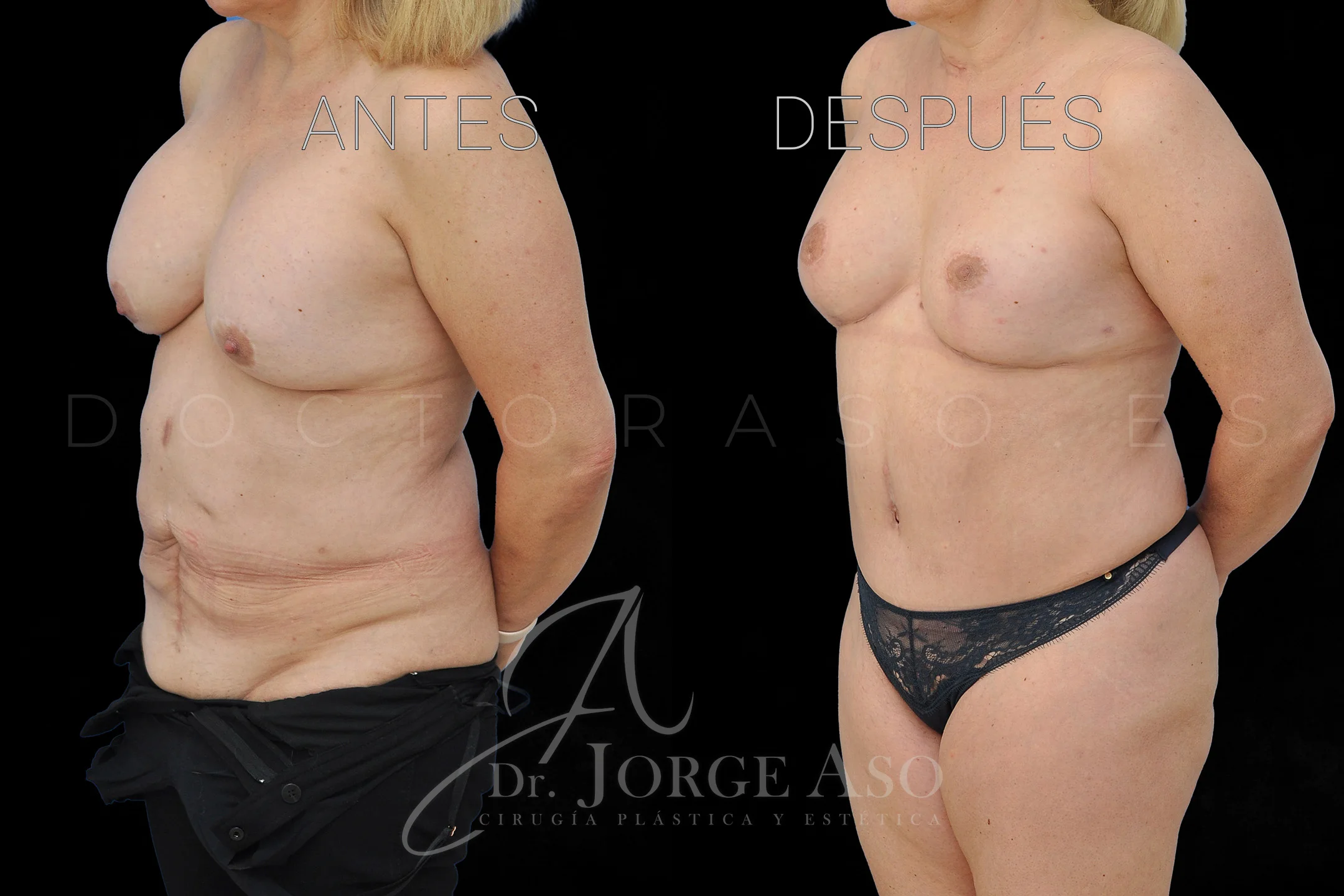 lipoabdominoplastia antes y después con reparación de diástasis de rectos vista oblicua