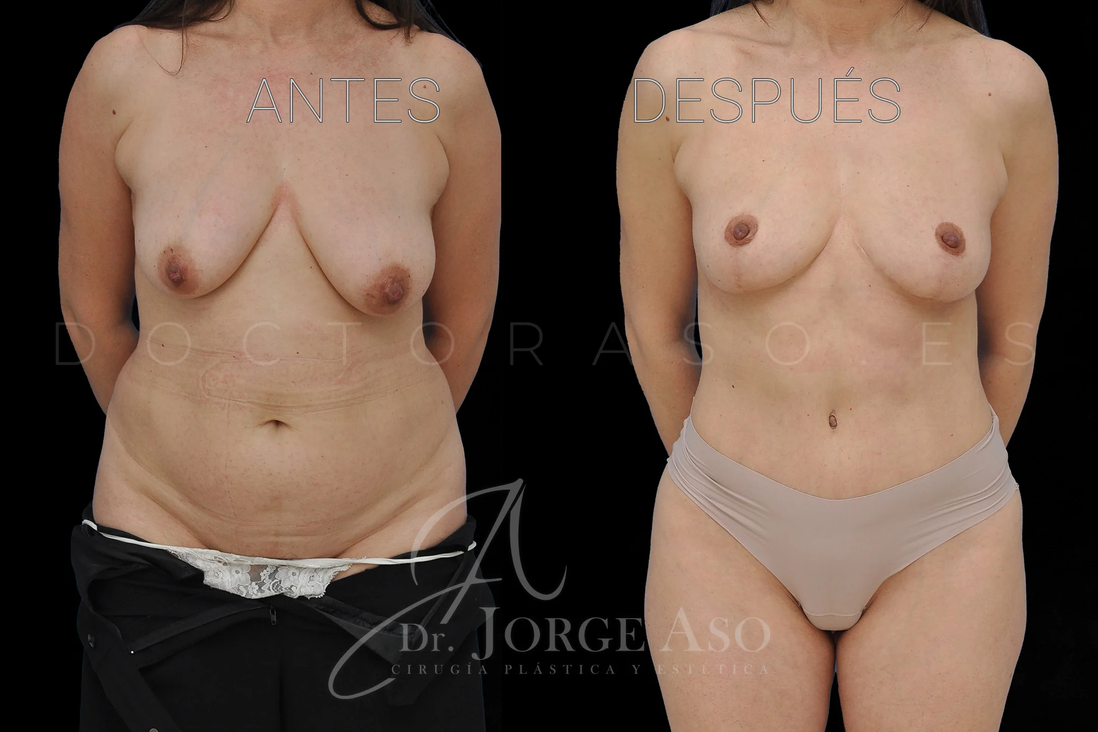 lipoabdominoplastia antes y después con reparación de diástasis de rectos vista frontal