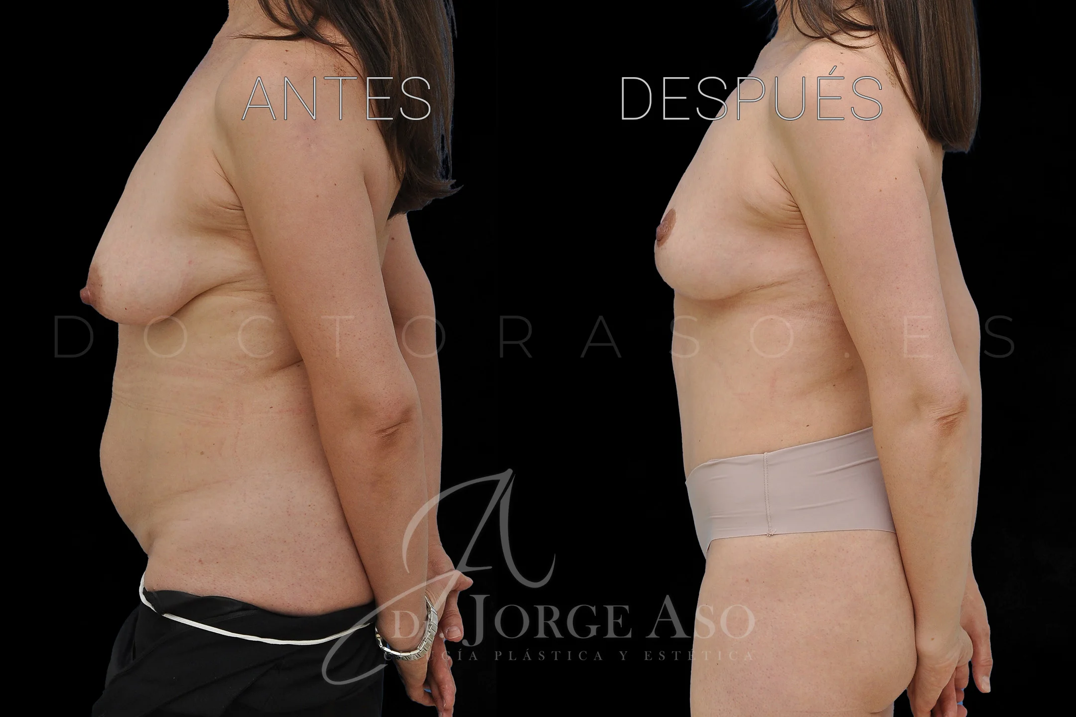 lipoabdominoplastia antes y después con reparación de diástasis de rectos vista lateral