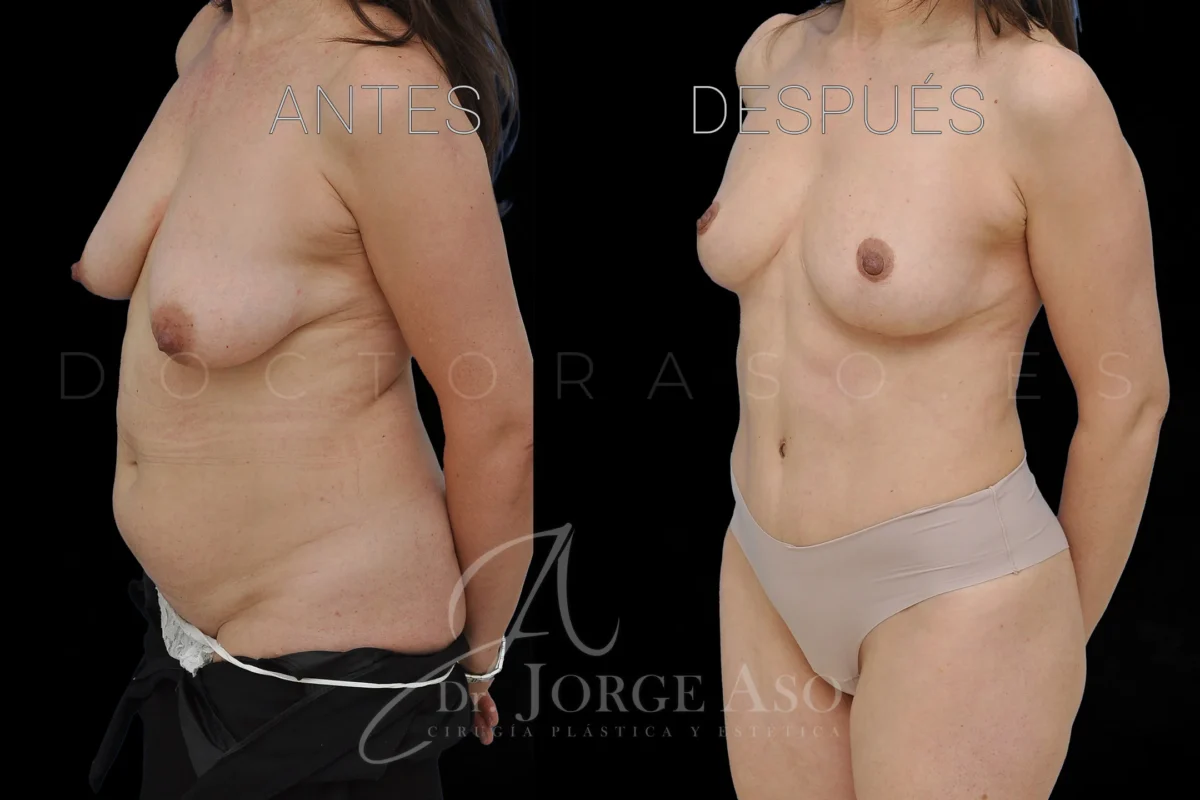 Antes y después de lipoabdominoplastia con reparación de diástasis, caso clínico 17