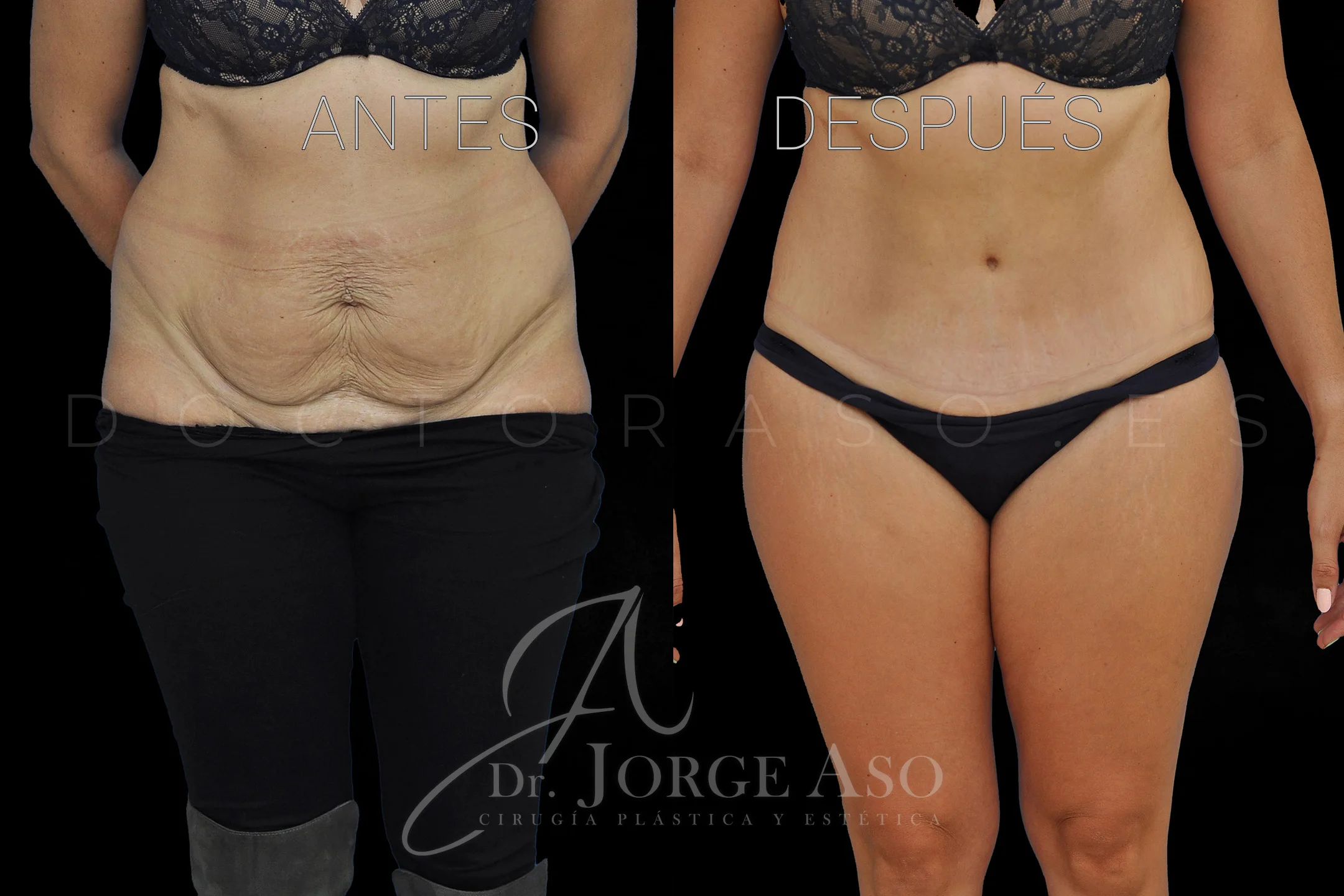 lipoabdominoplastia antes y después con reparación de diástasis de rectos vista frontal