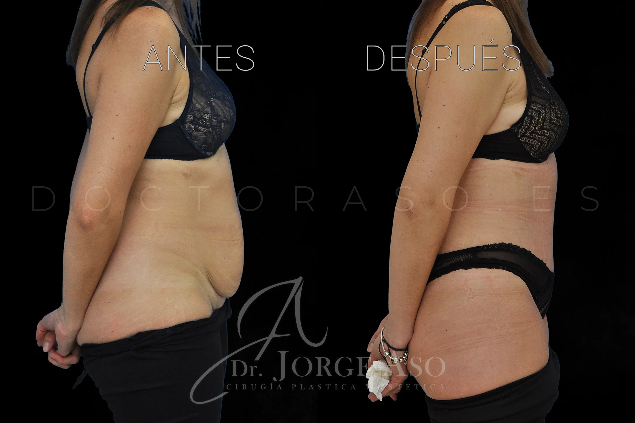 lipoabdominoplastia antes y después con reparación de diástasis de rectos vista lateral