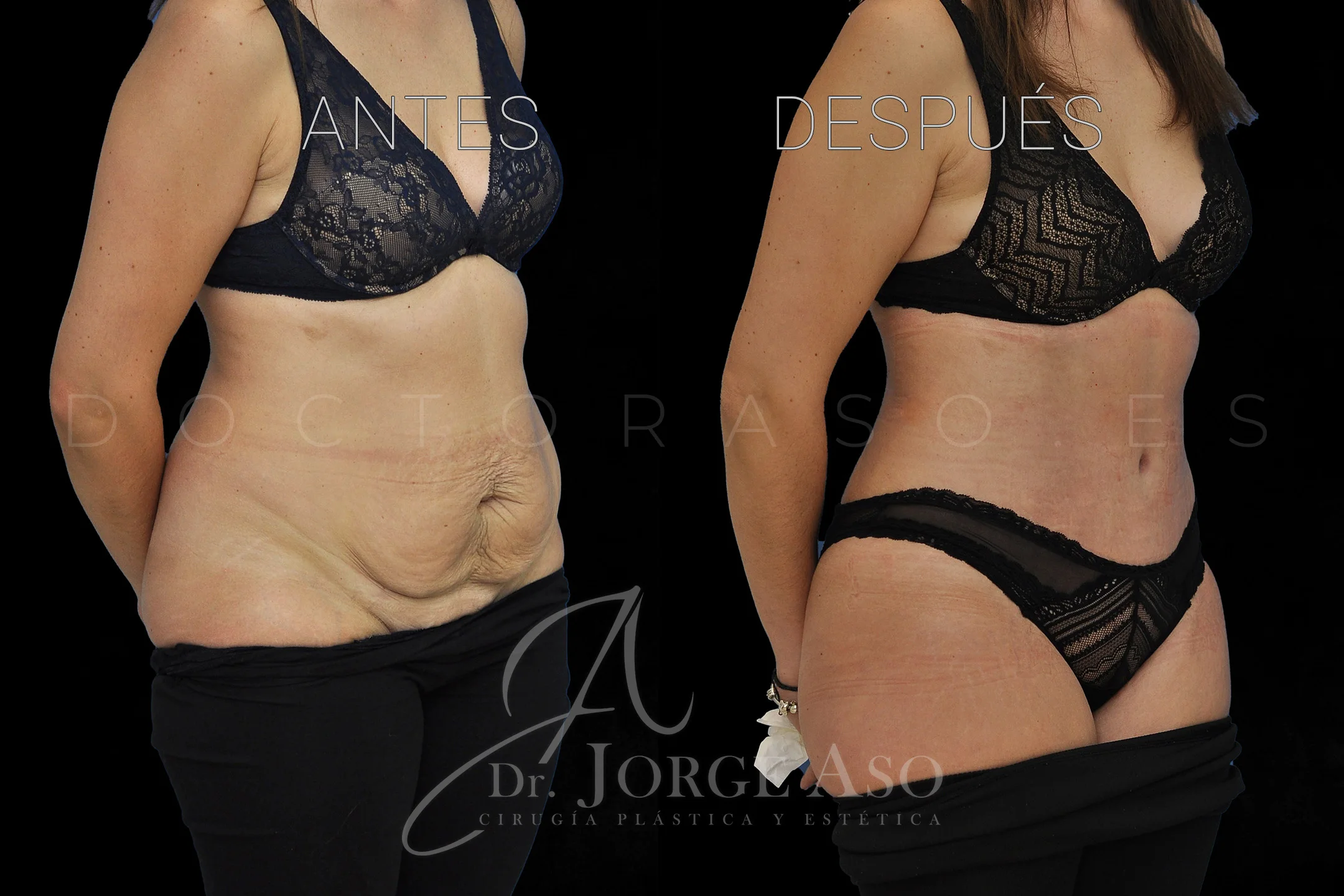 lipoabdominoplastia antes y después con reparación de diástasis de rectos vista oblicua