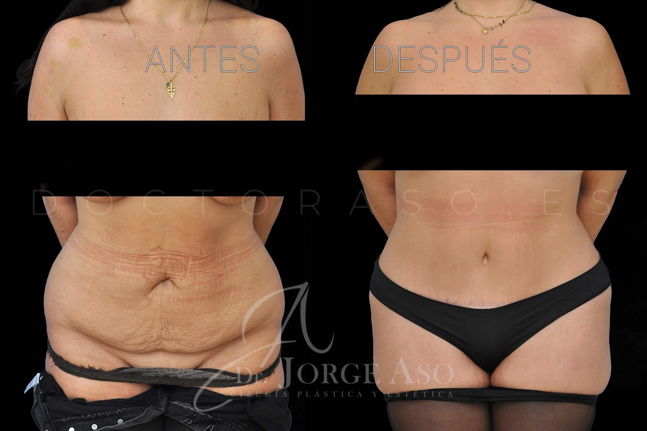 lipoabdominoplastia antes y después con reparación de diástasis de rectos vista frontal