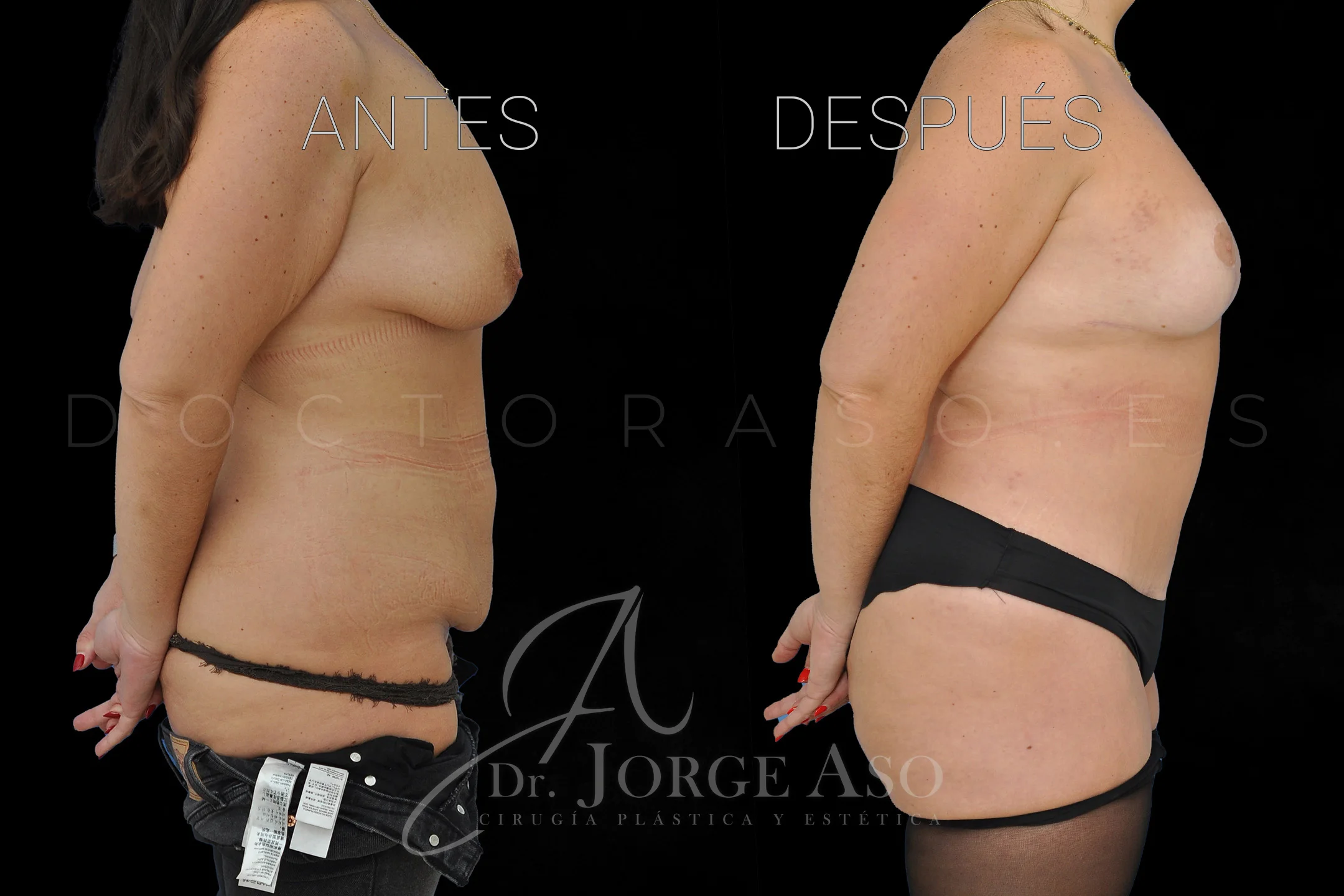 lipoabdominoplastia antes y después con reparación de diástasis de rectos vista lateral