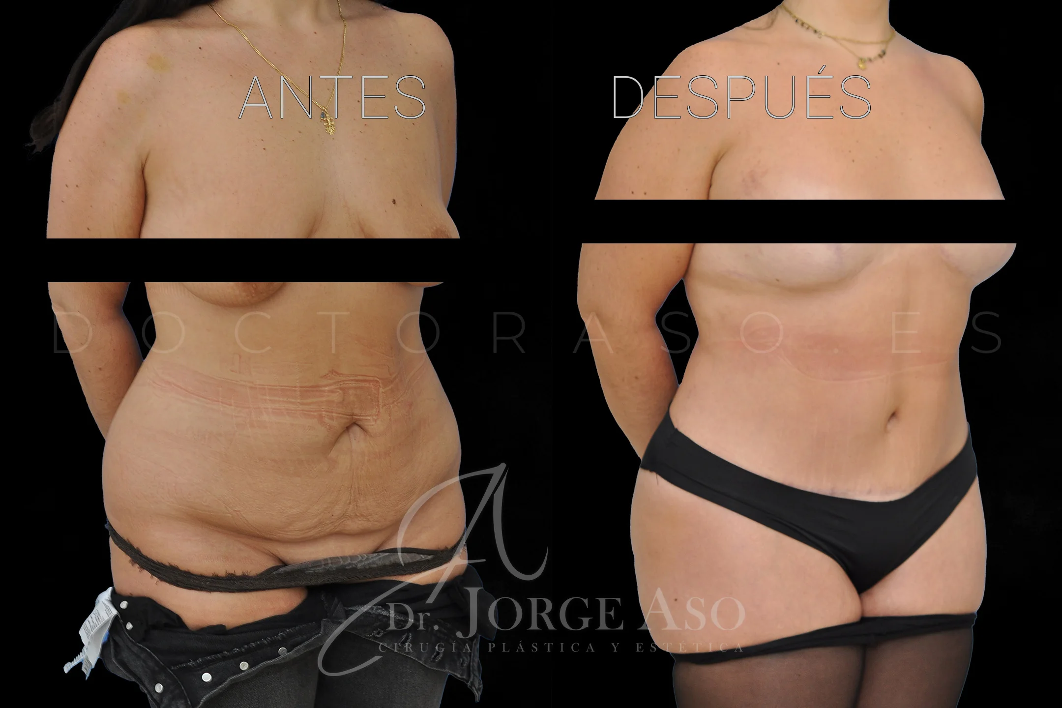 lipoabdominoplastia antes y después con reparación de diástasis de rectos vista oblicua