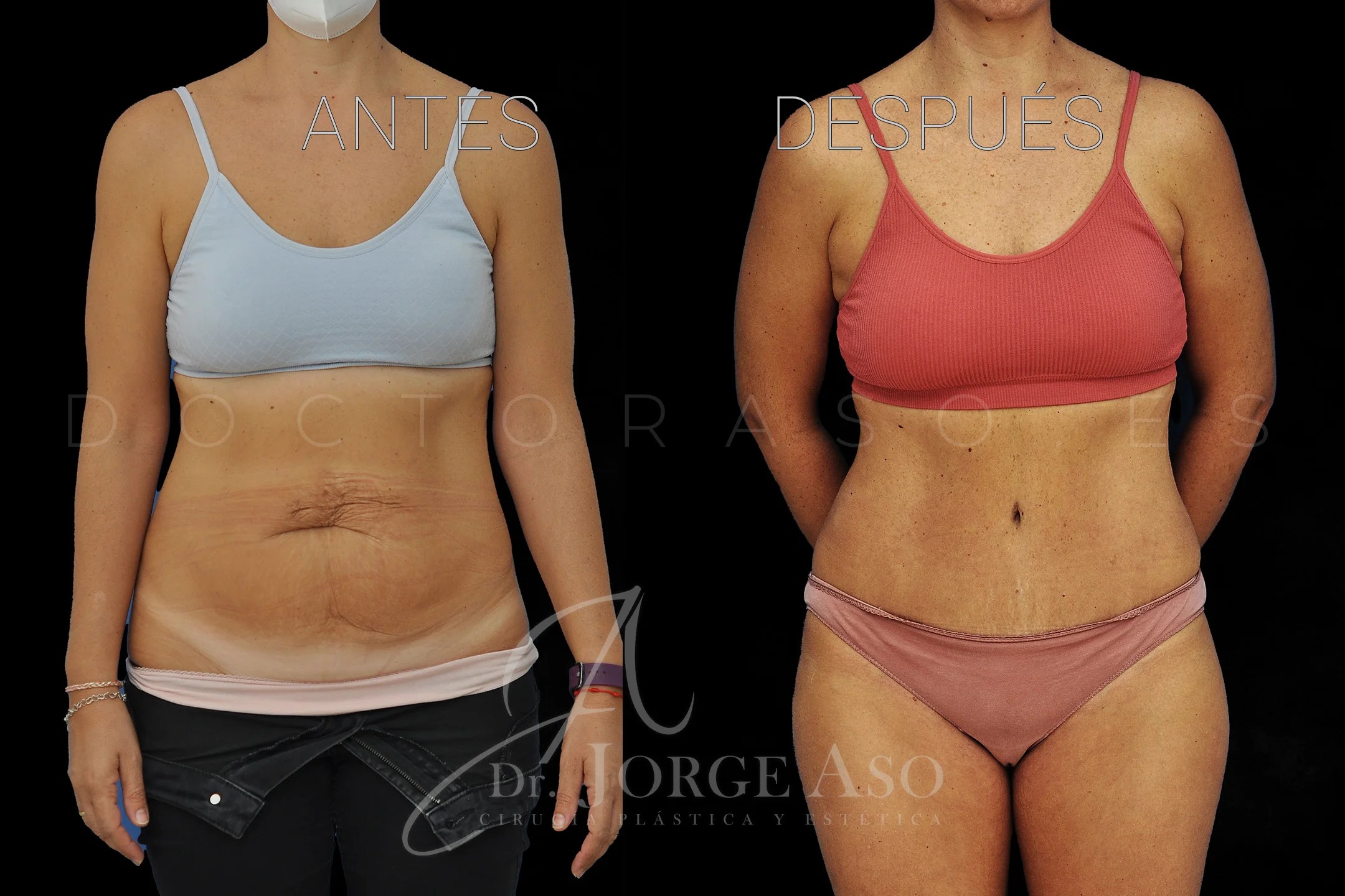 lipoabdominoplastia antes y después con reparación de diástasis de rectos vista frontal
