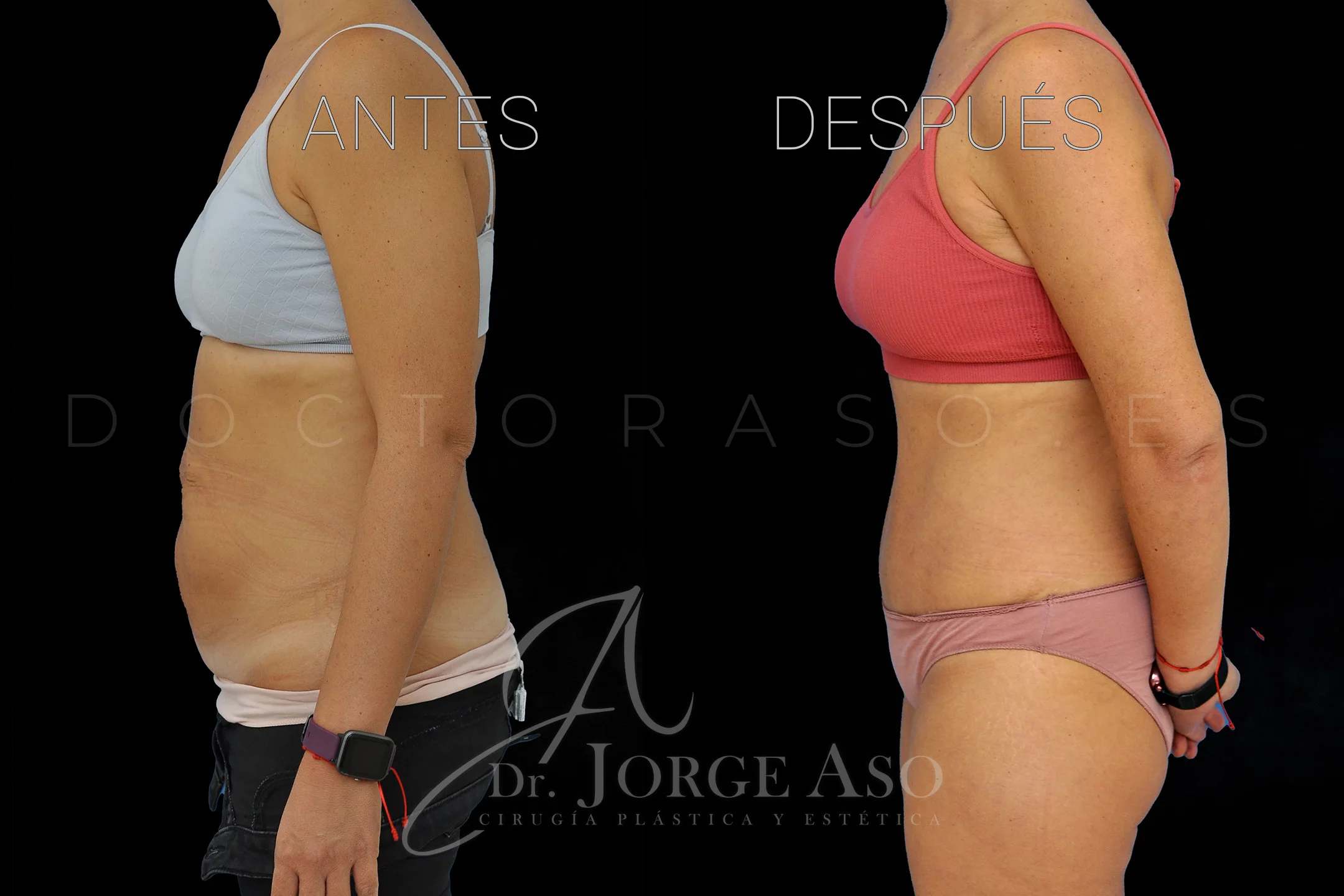 lipoabdominoplastia antes y después con reparación de diástasis de rectos vista lateral