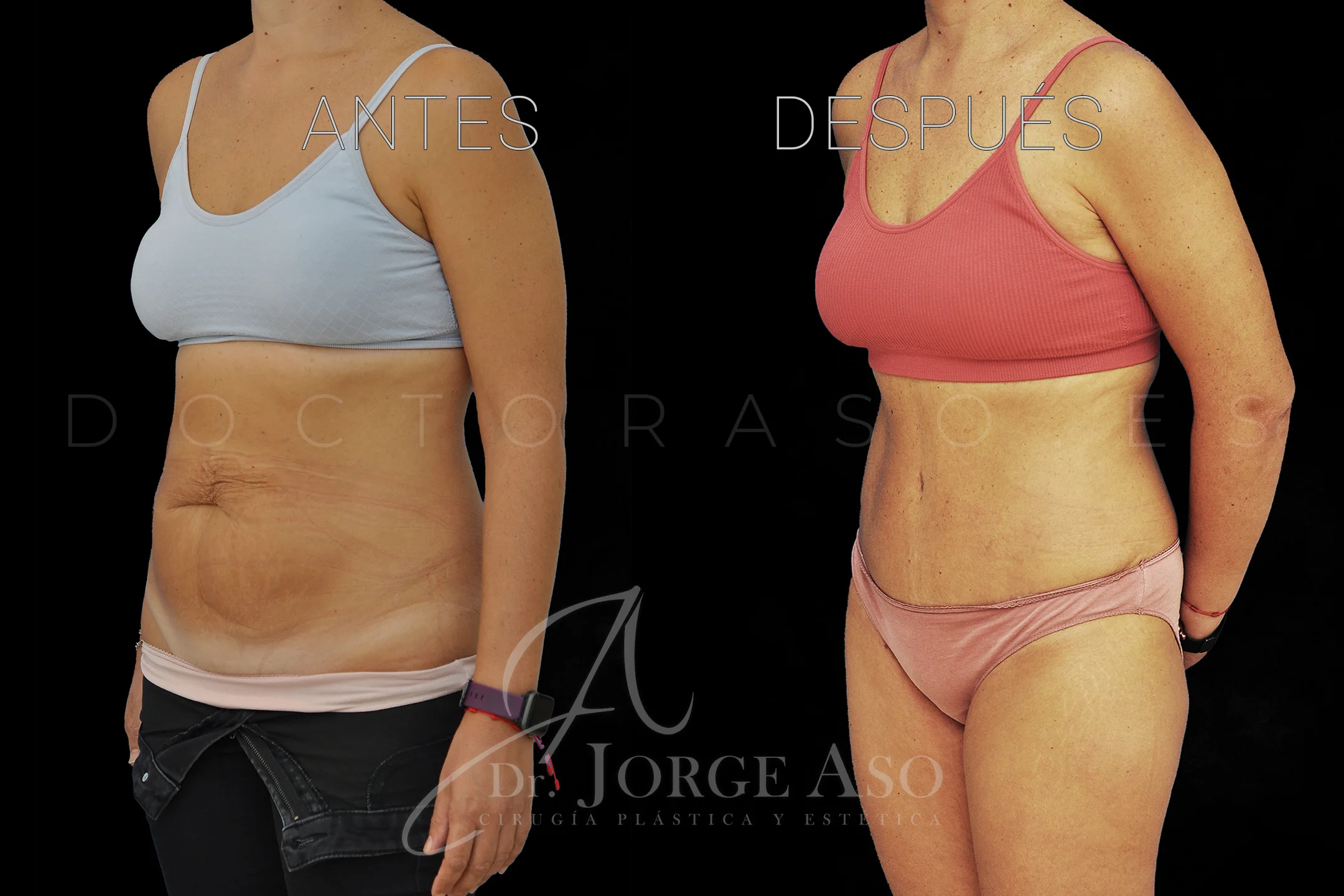 lipoabdominoplastia antes y después con reparación de diástasis de rectos vista oblicua