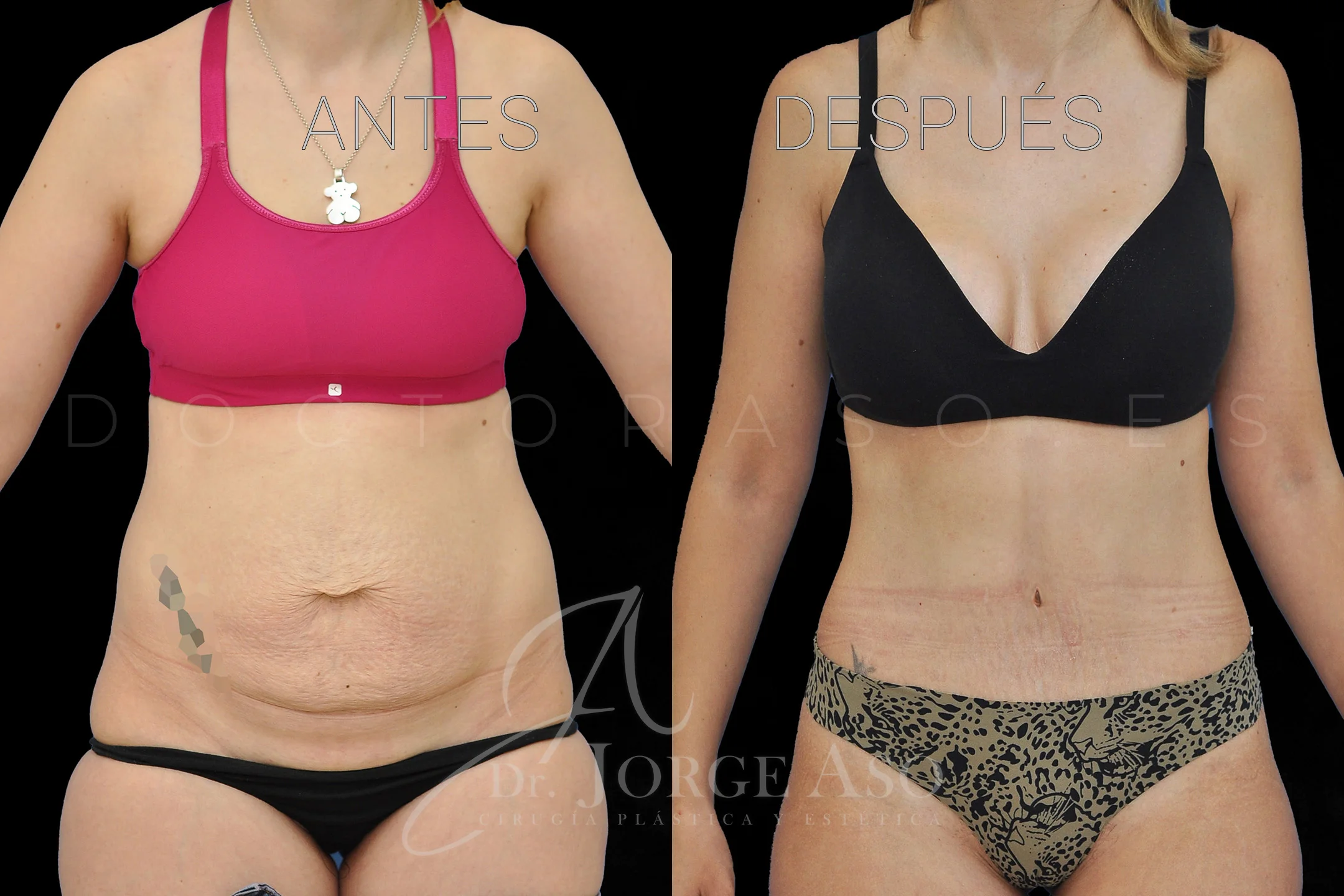 lipoabdominoplastia antes y después con reparación de diástasis de rectos vista frontal