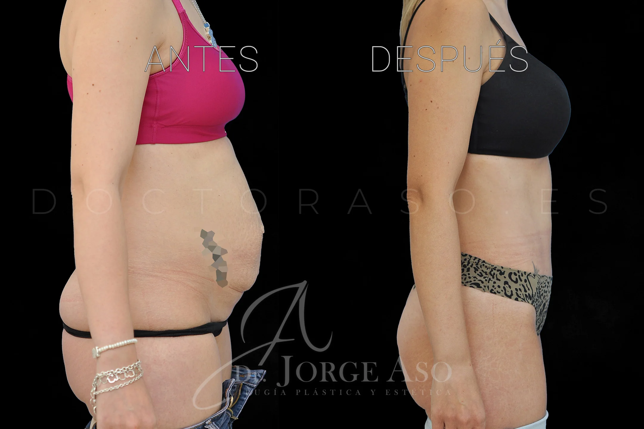 lipoabdominoplastia antes y después con reparación de diástasis de rectos vista lateral