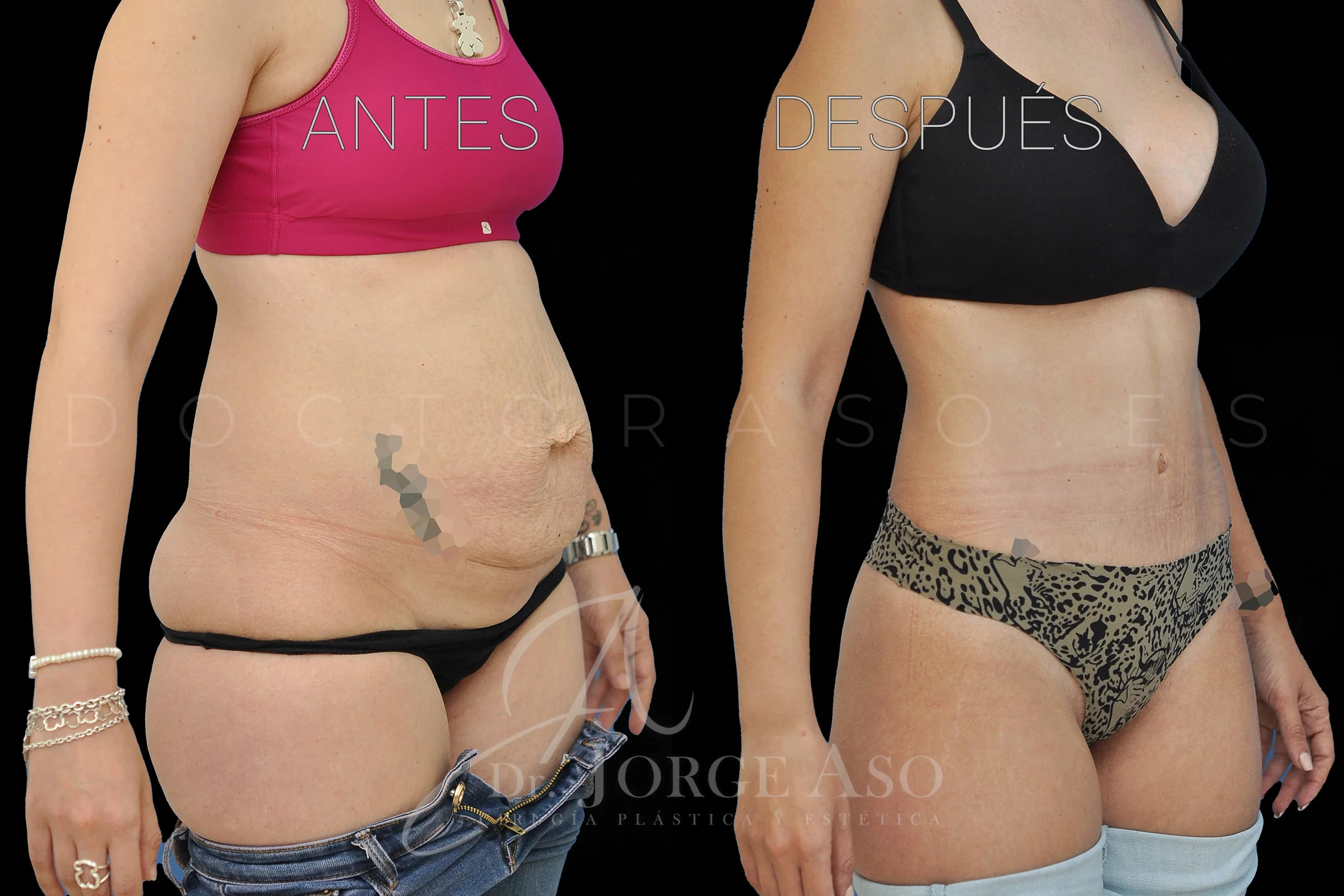 lipoabdominoplastia antes y después con reparación de diástasis de rectos vista oblicua
