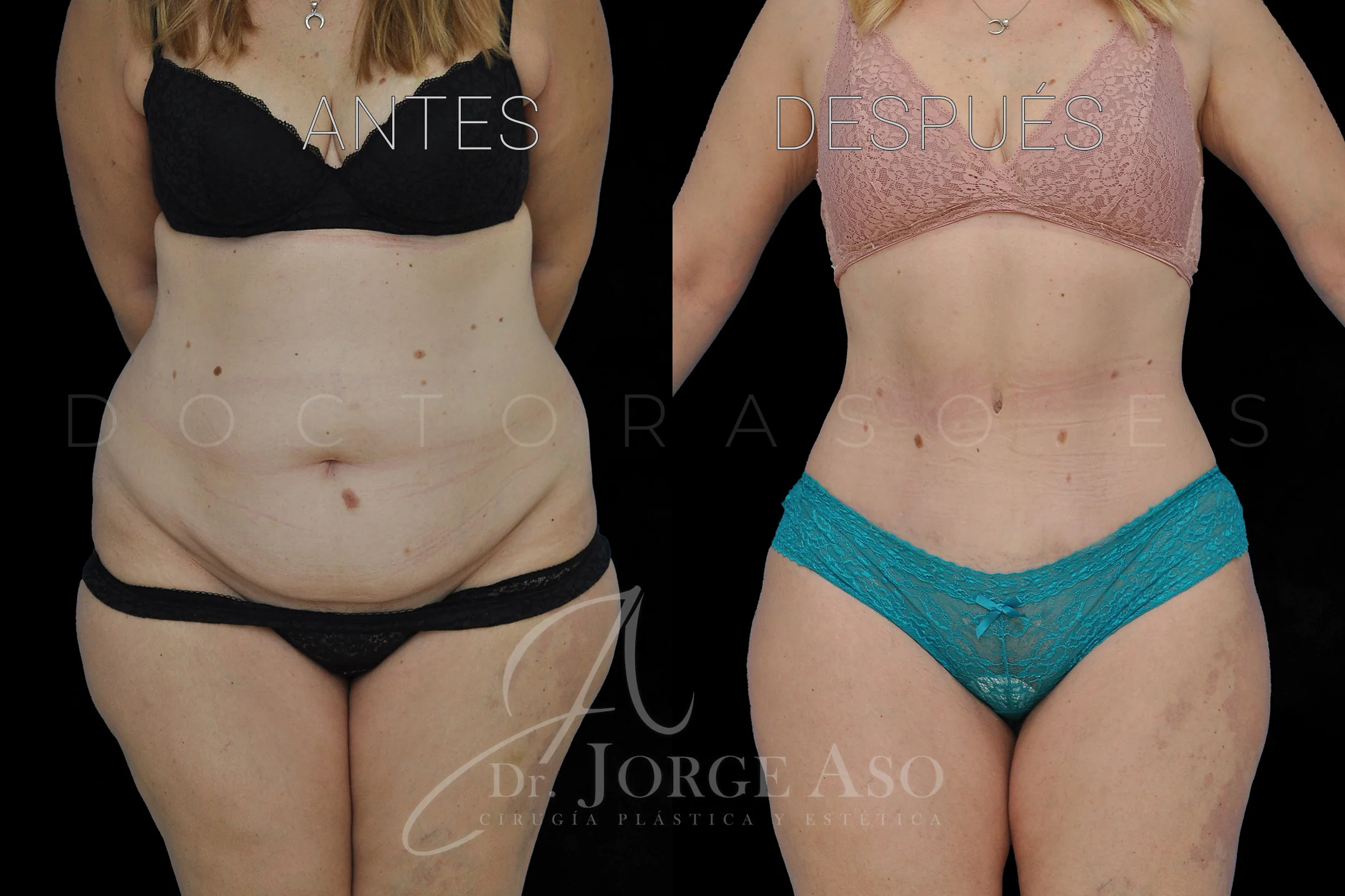 lipoabdominoplastia antes y después con reparación de diástasis de rectos vista frontal