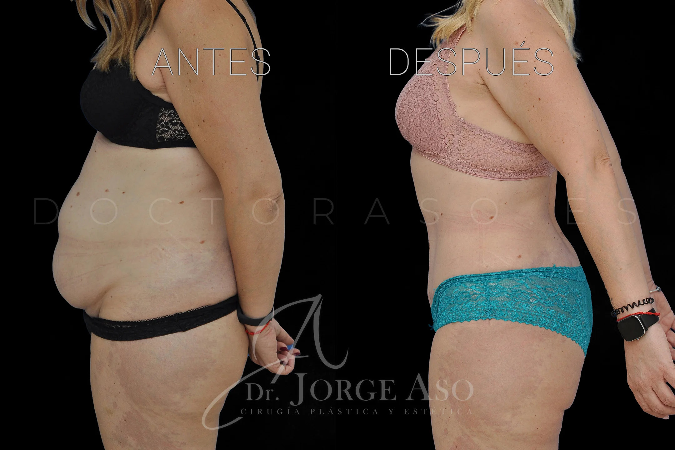 lipoabdominoplastia antes y después con reparación de diástasis de rectos vista lateral