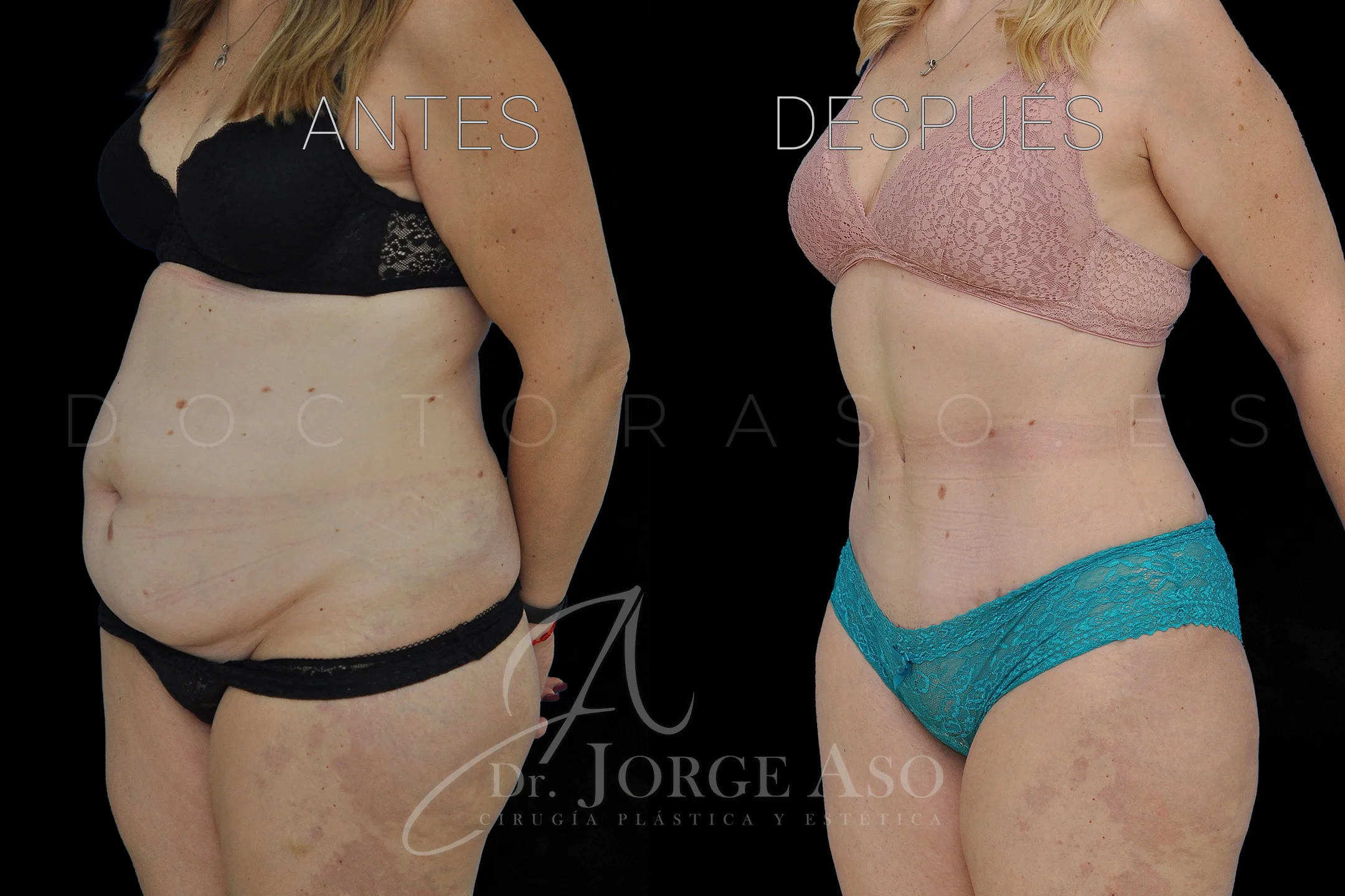 lipoabdominoplastia antes y después con reparación de diástasis de rectos vista oblicua