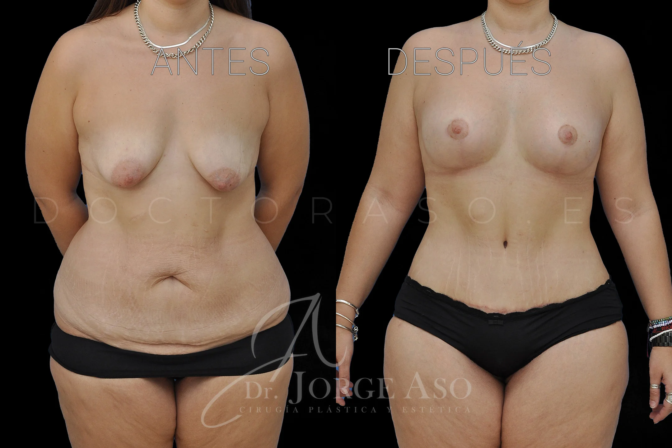 lipoabdominoplastia antes y después con reparación de diástasis de rectos vista frontal