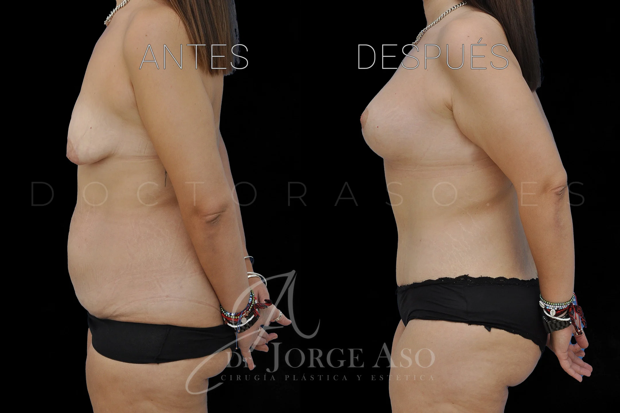 lipoabdominoplastia antes y después con reparación de diástasis de rectos vista lateral