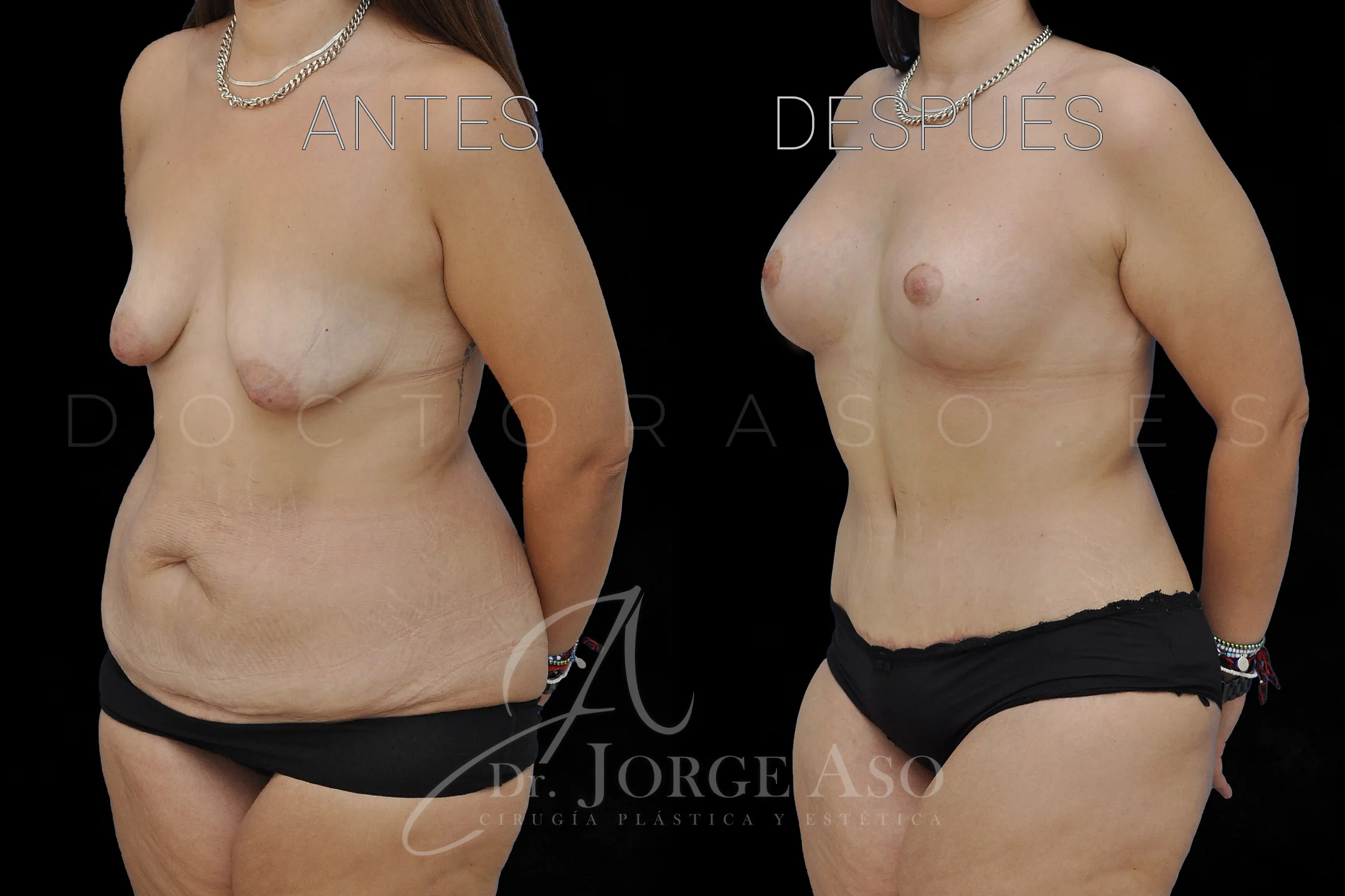 lipoabdominoplastia antes y después con reparación de diástasis de rectos vista oblicua