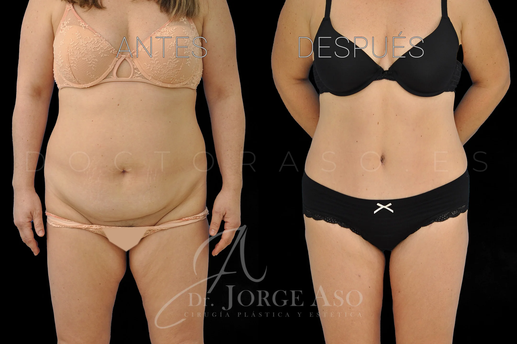 lipoabdominoplastia antes y después con reparación de diástasis de rectos vista frontal