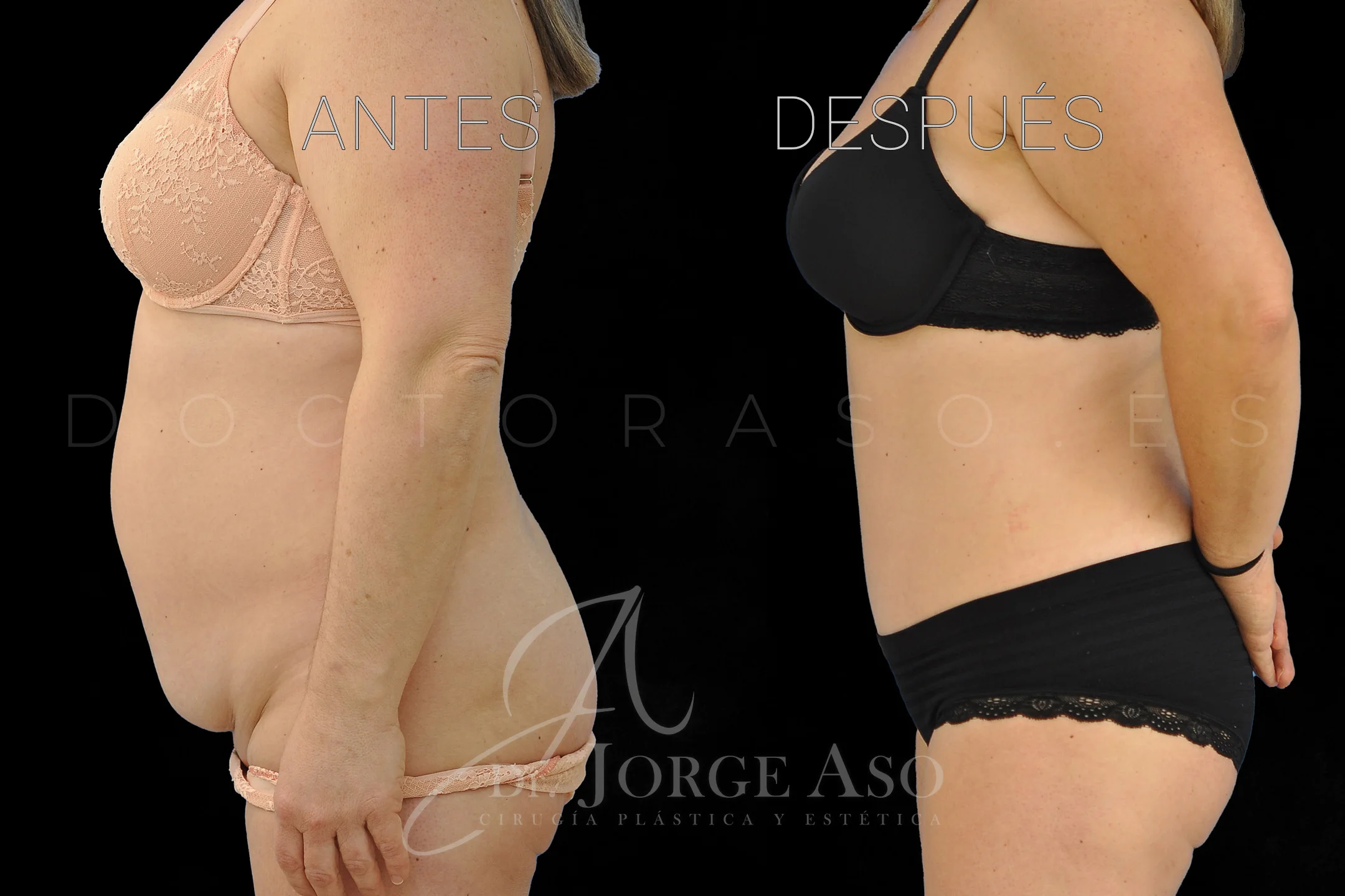 lipoabdominoplastia antes y después con reparación de diástasis de rectos vista lateral