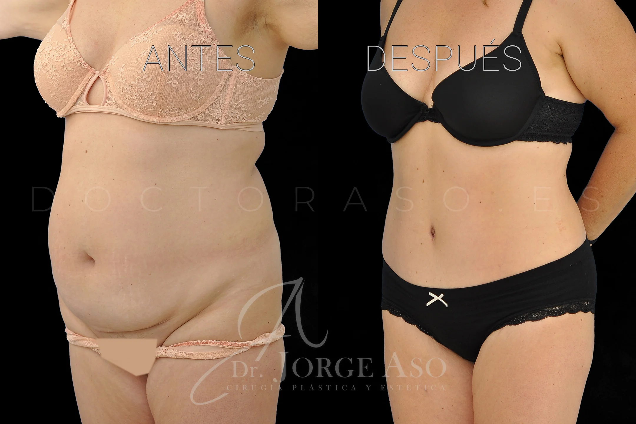 lipoabdominoplastia antes y después con reparación de diástasis de rectos vista oblicua