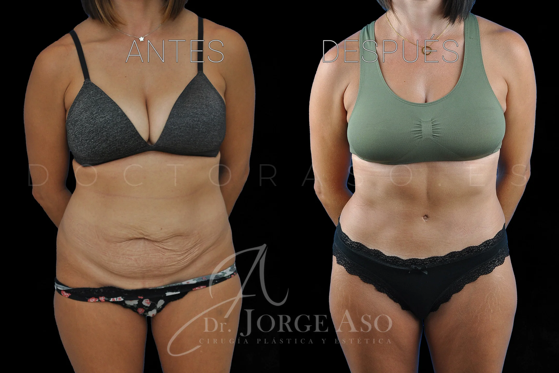lipoabdominoplastia antes y después con reparación de diástasis de rectos vista frontal