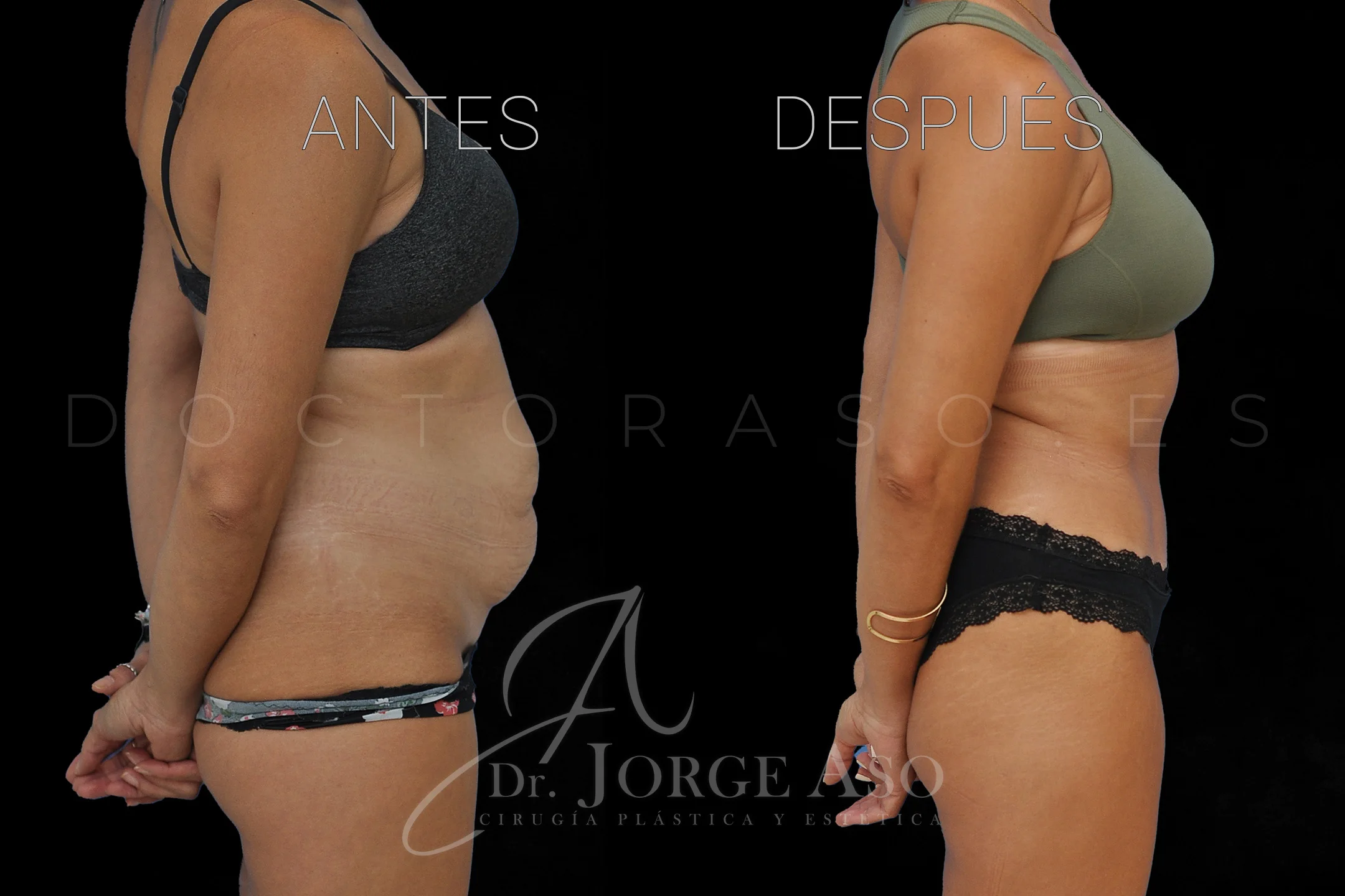 lipoabdominoplastia antes y después con reparación de diástasis de rectos vista lateral