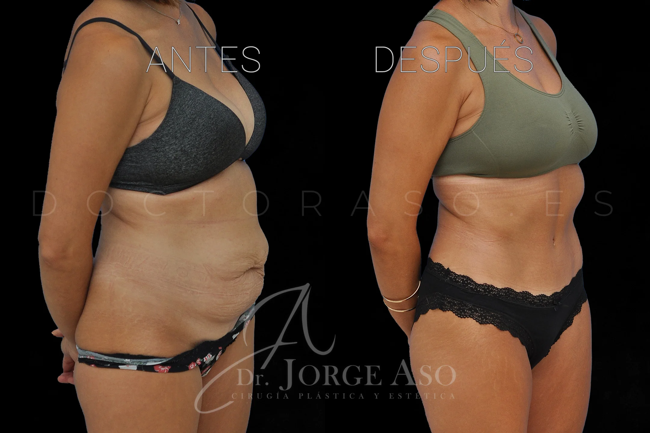 lipoabdominoplastia antes y después con reparación de diástasis de rectos vista oblicua