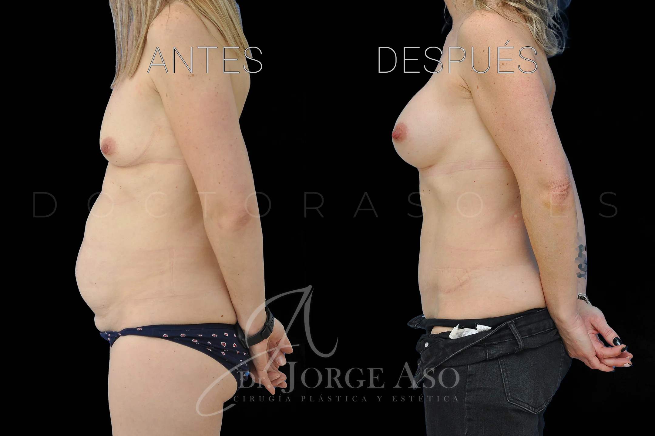 lipoabdominoplastia antes y después con reparación de diástasis de rectos vista lateral