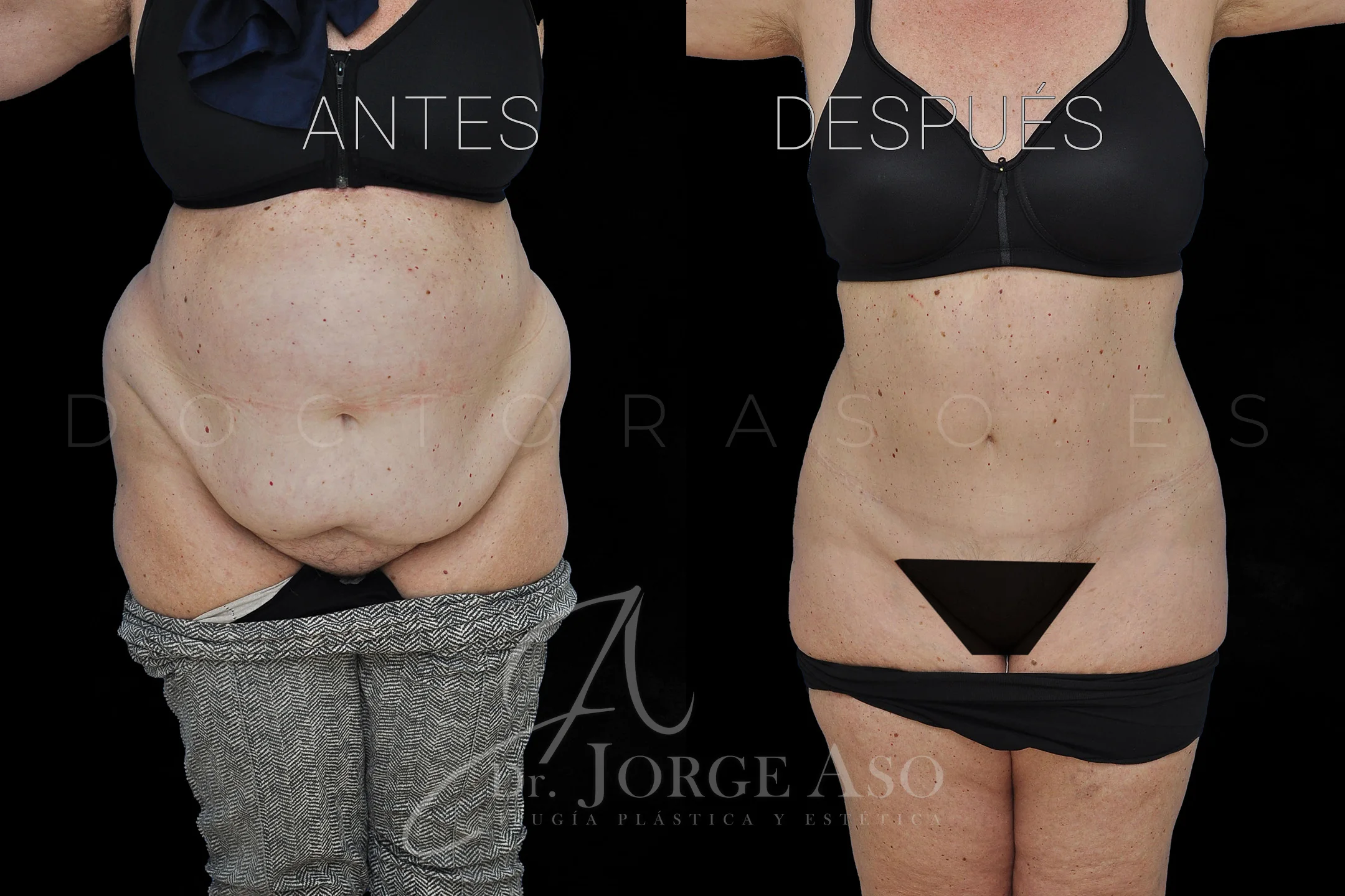 lipoabdominoplastia antes y después con reparación de diástasis de rectos vista frontal