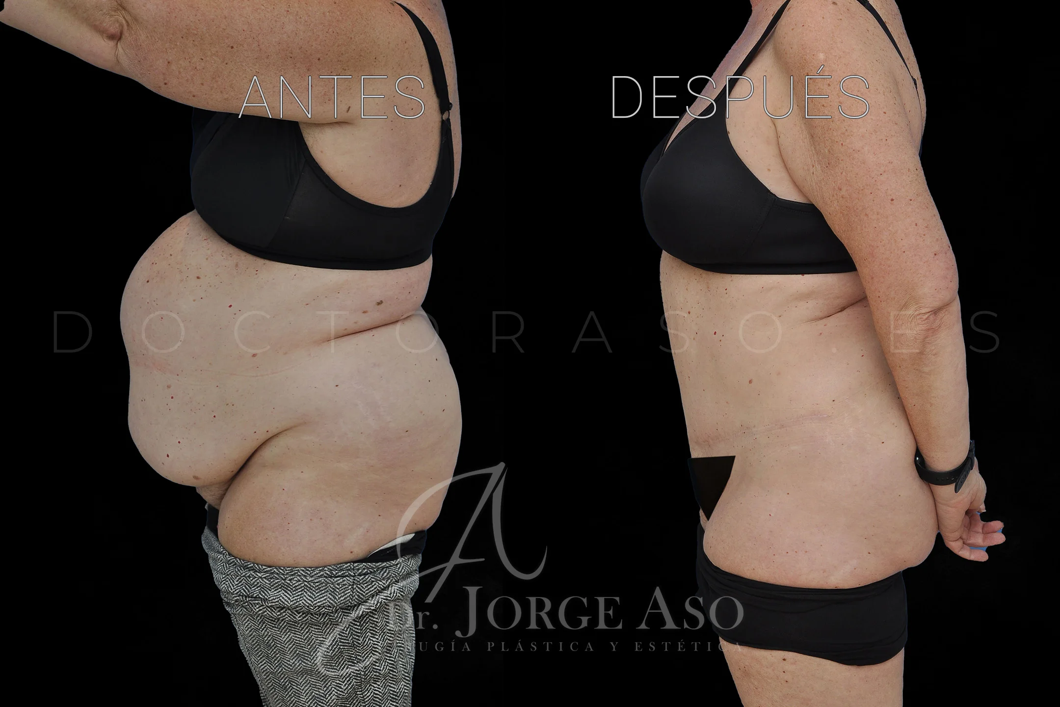lipoabdominoplastia antes y después con reparación de diástasis de rectos vista lateral