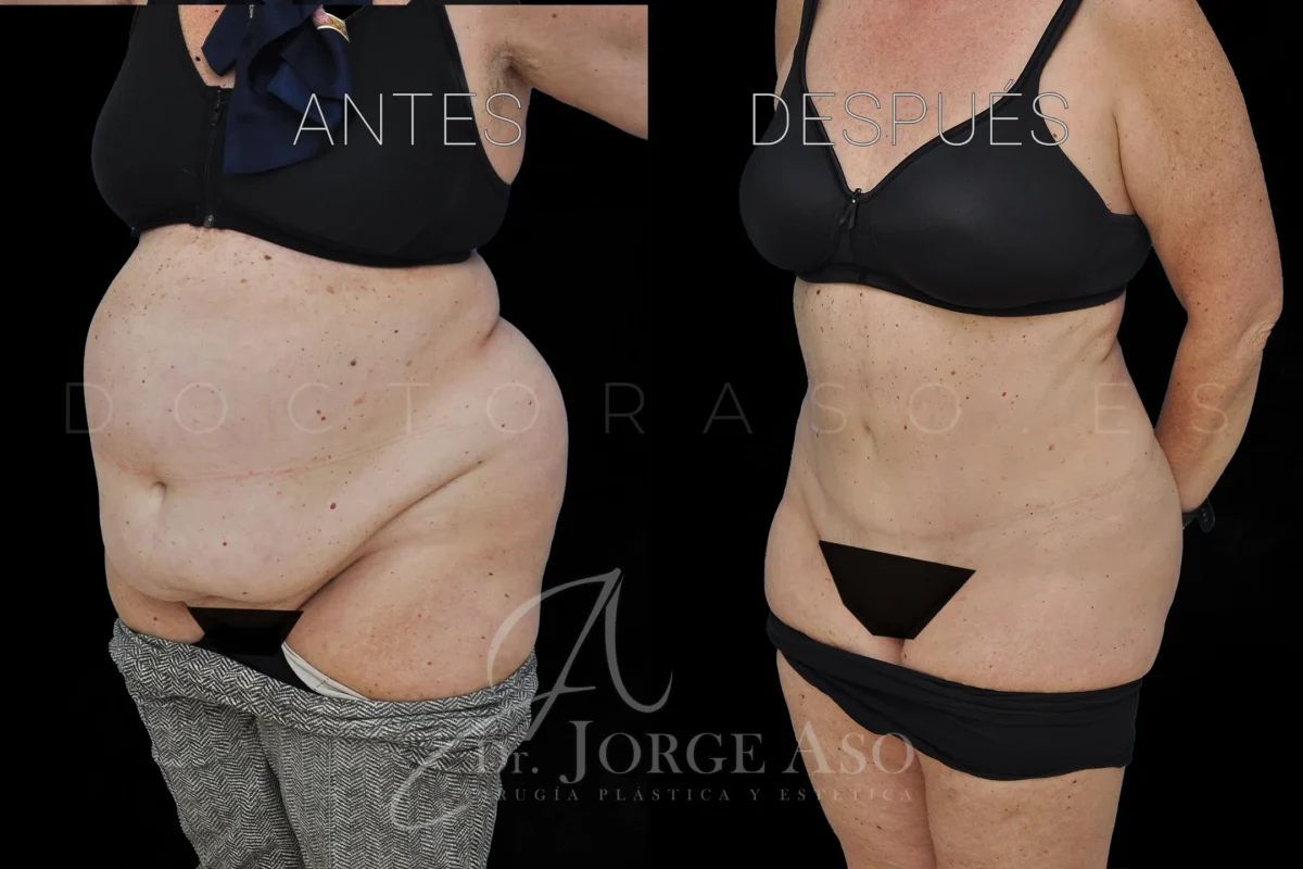 Antes y después de lipoabdominoplastia con reparación de diástasis, caso clínico 4