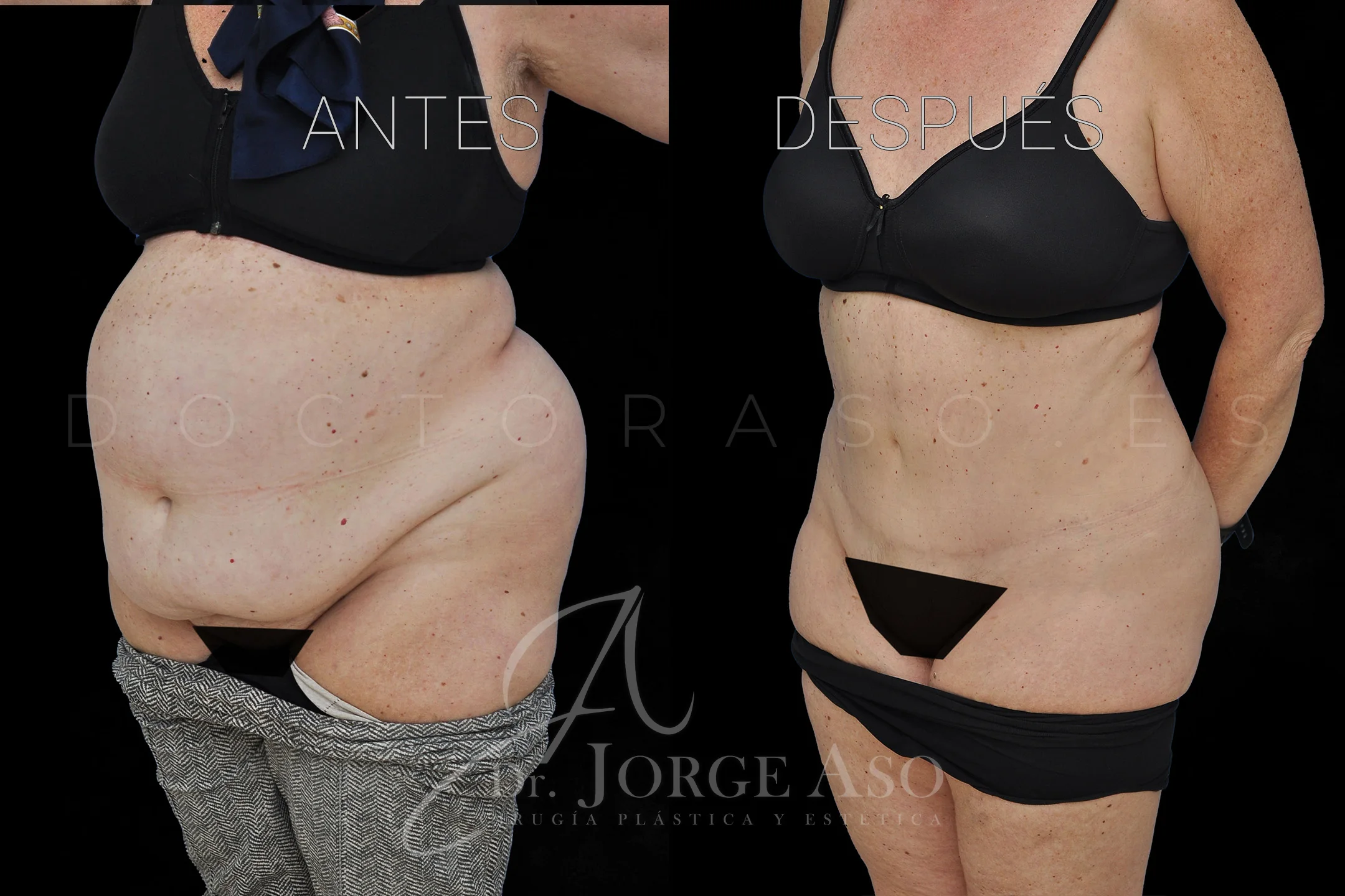 lipoabdominoplastia antes y después con reparación de diástasis de rectos vista oblicua