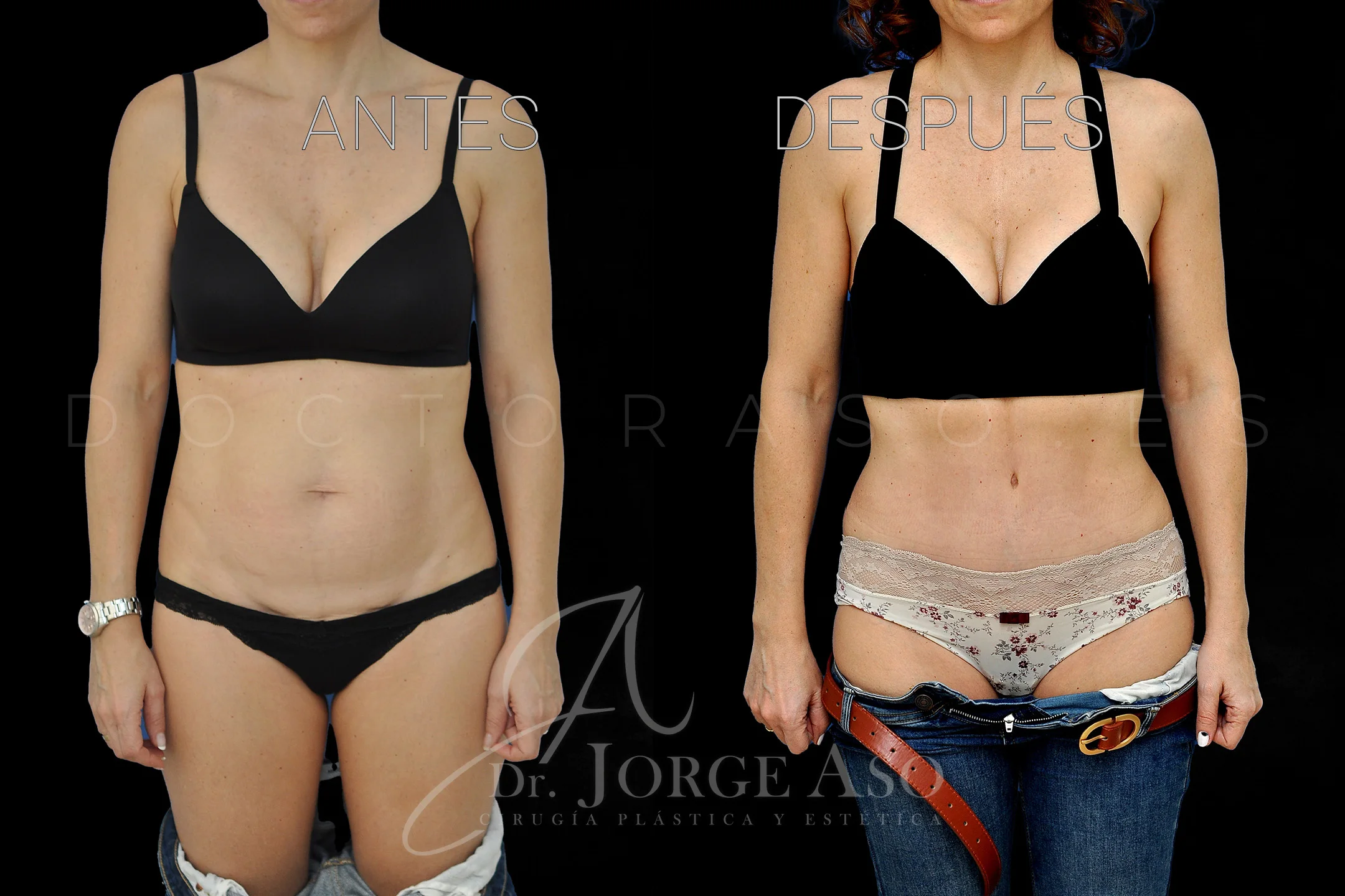 lipoabdominoplastia antes y después con reparación de diástasis de rectos vista frontal