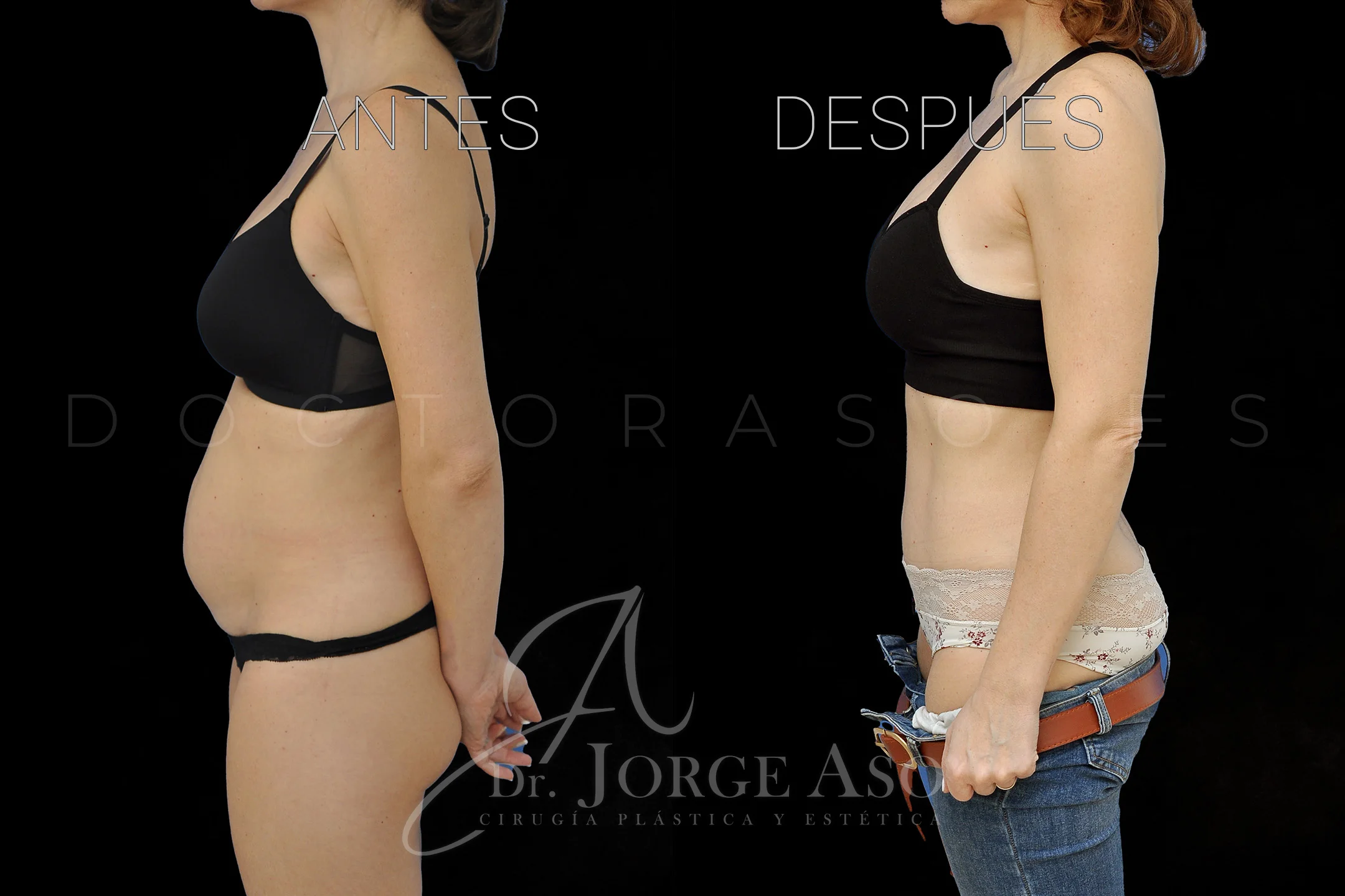 lipoabdominoplastia antes y después con reparación de diástasis de rectos vista lateral
