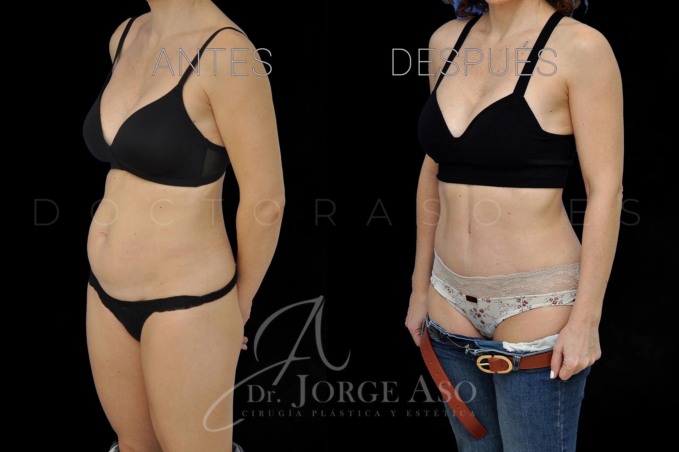 lipoabdominoplastia antes y después con reparación de diástasis de rectos vista oblicua