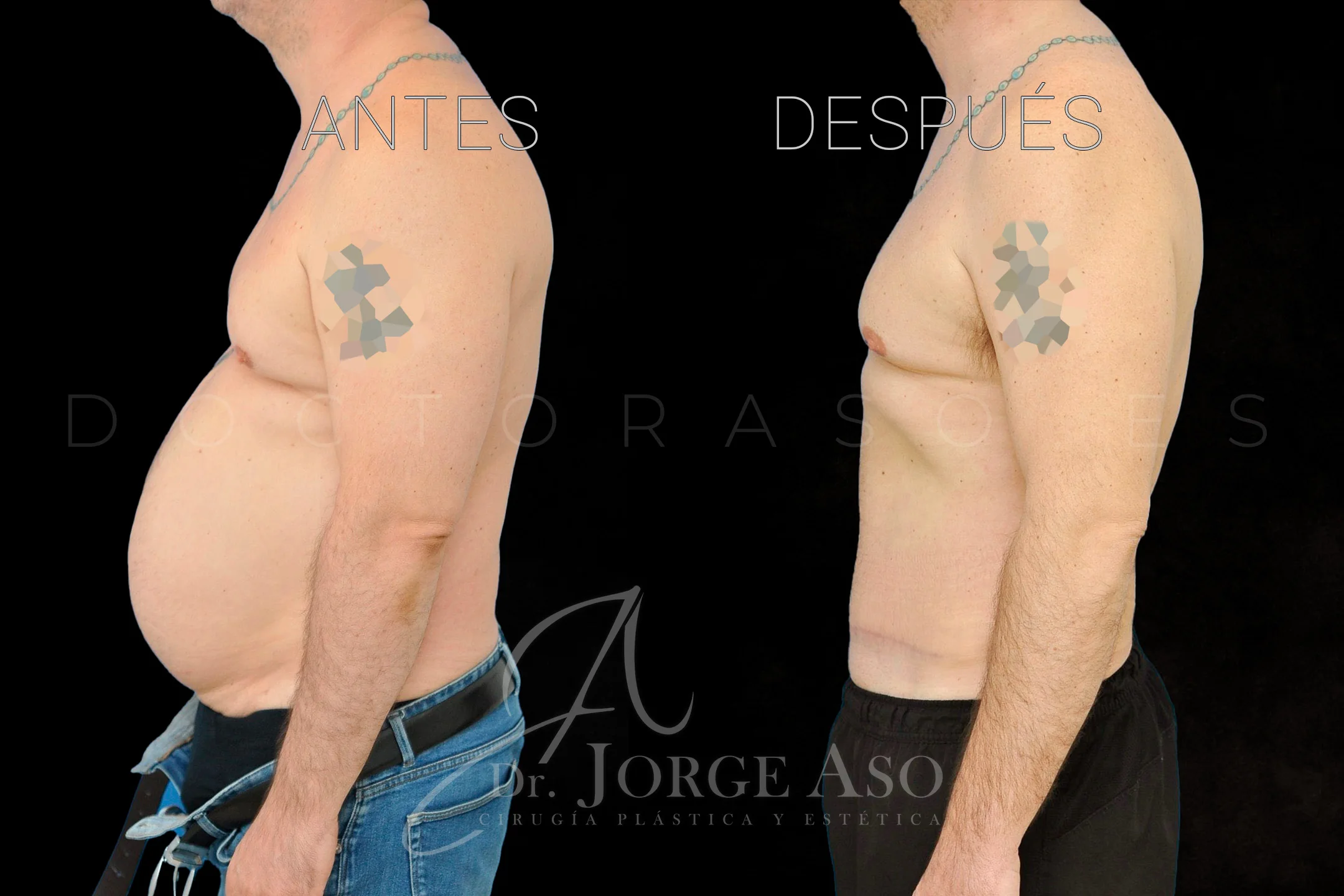 lipoabdominoplastia antes y después con reparación de diástasis de rectos vista lateral