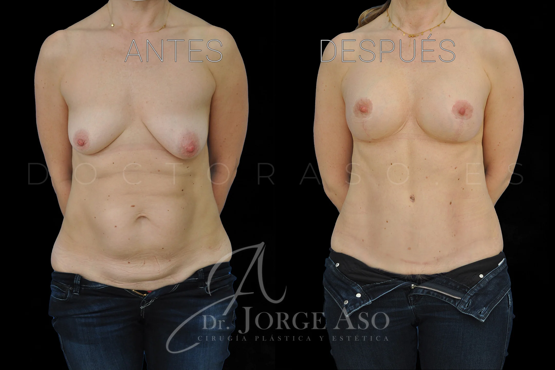 lipoabdominoplastia antes y después con reparación de diástasis de rectos vista frontal