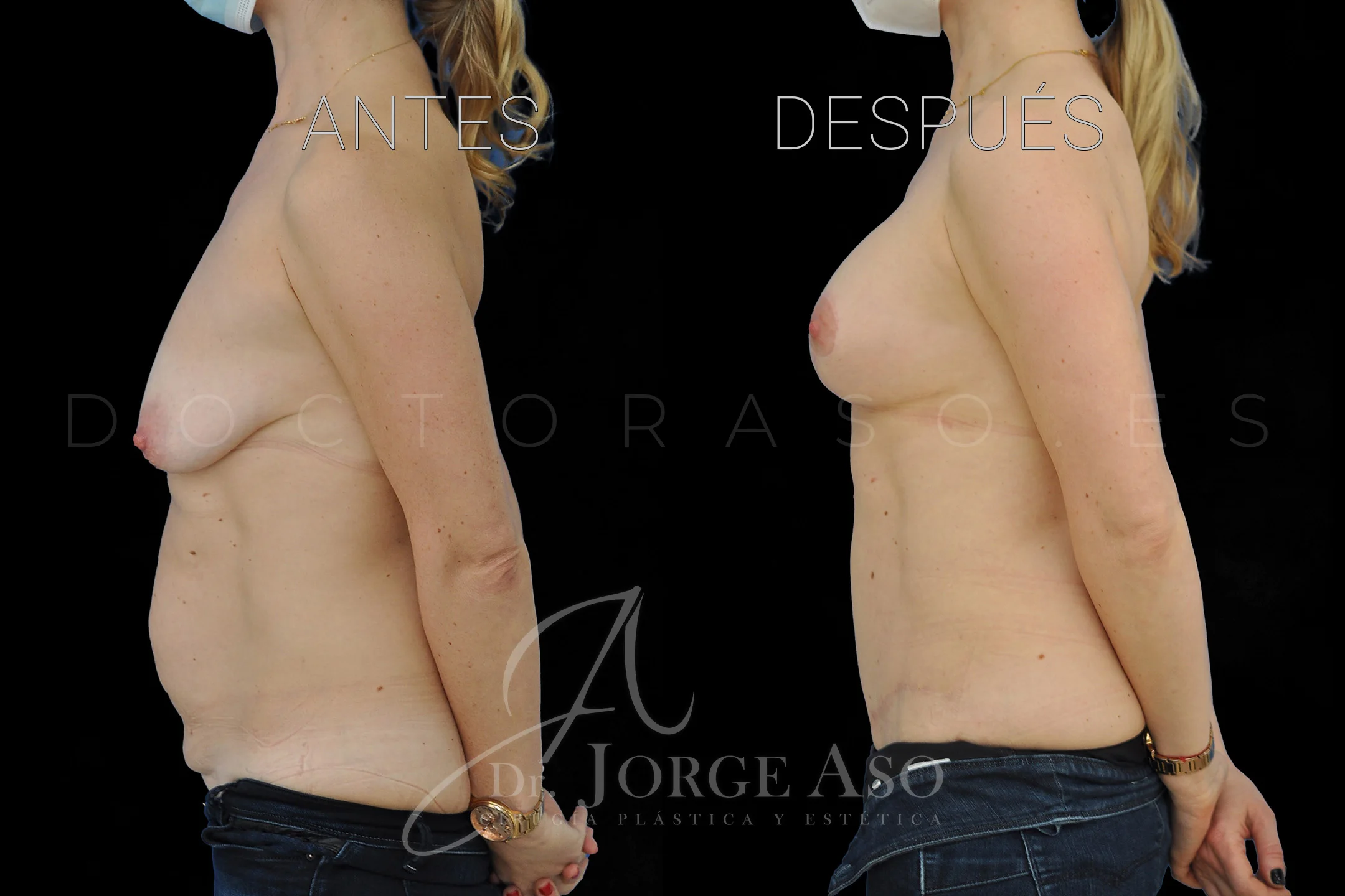 lipoabdominoplastia antes y después con reparación de diástasis de rectos vista lateral