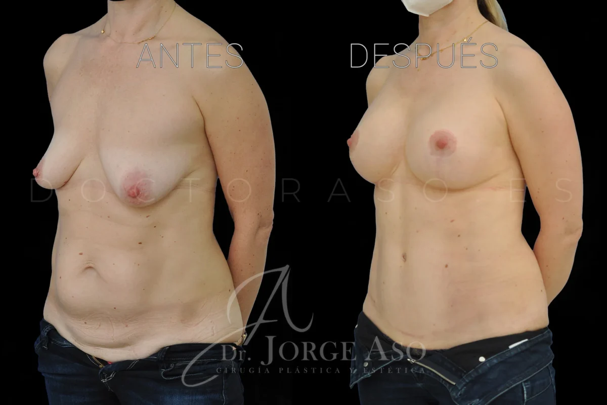 Lipoabdominoplastia antes y después con reparación de diástasis, vista oblicua, caso 7