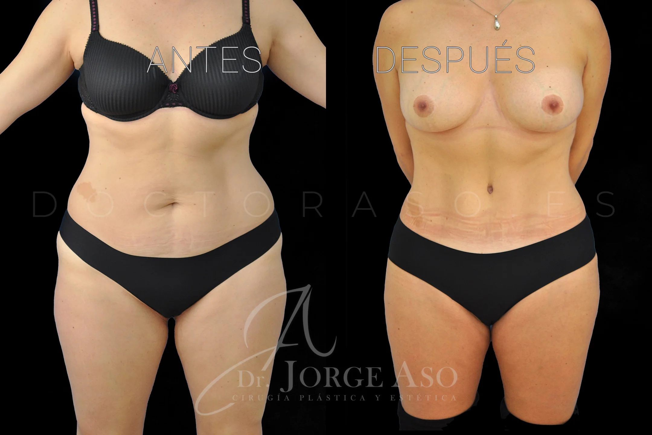 lipoabdominoplastia antes y después con reparación de diástasis de rectos vista frontal