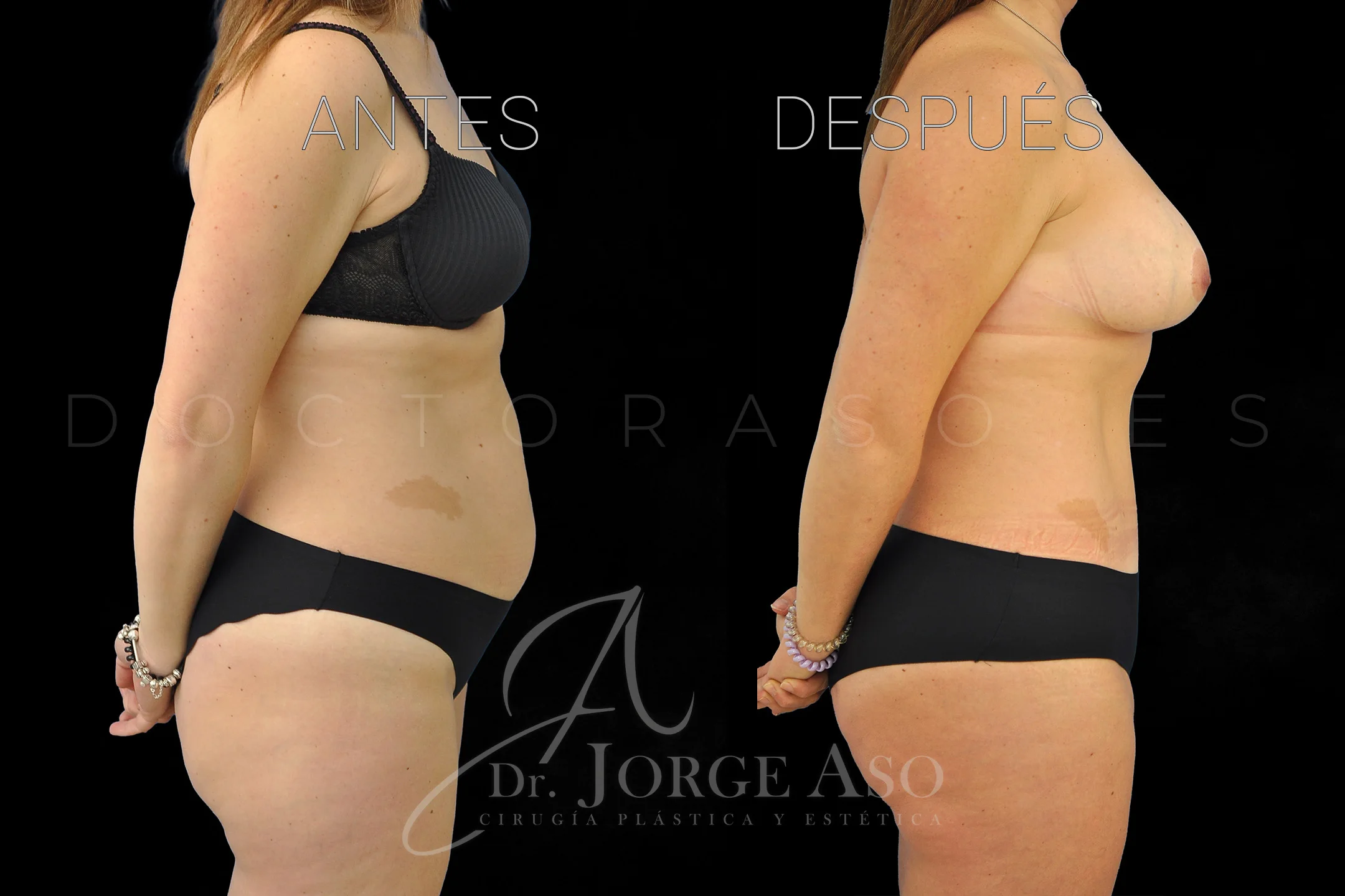lipoabdominoplastia antes y después con reparación de diástasis de rectos vista lateral