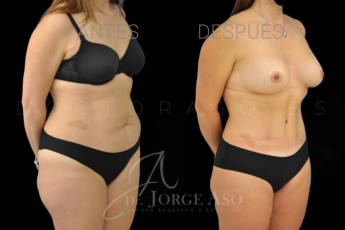 Lipoabdominoplastia antes y después con reparación de diástasis, vista oblicua, caso 8